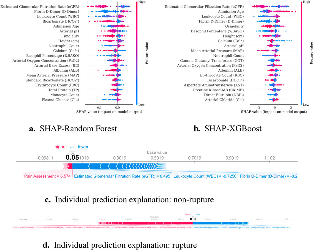 Two SHAP plots analyze feature impacts on model predictions. Plot a compares features using Random Forest, showing eGFR, D-Dimer, and WBC as key factors. Plot b, using XGBoost, highlights Admission Age and WBC. Labels indicate feature influence values. Below, individual prediction explanations c and d contrast cases of non-rupture and rupture, with respective SHAP values and feature contributions noted.