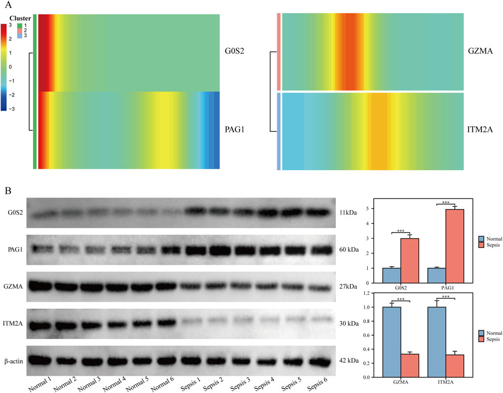 Heatmap and protein expression analysis. A) Heatmap displays expression clusters for G0S2, PAG1, GZMA, and ITM2A across samples. B) Western blots show protein expression of G0S2, PAG1, GZMA, ITM2A, and β-actin in normal and sepsis conditions. Bar graphs compare expression levels in normal and sepsis groups, highlighting significant differences for each protein.