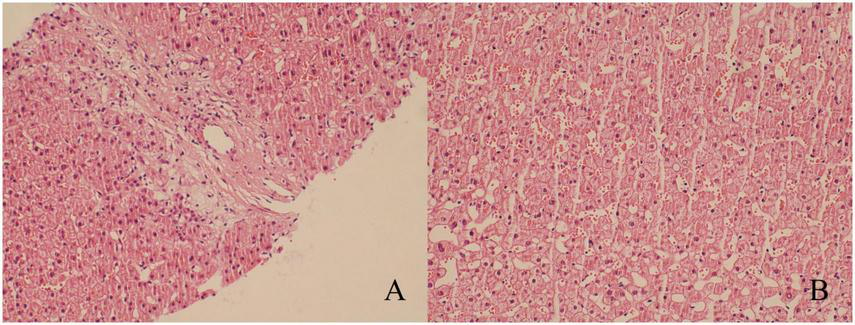 Histological comparison of two liver tissue samples labeled A and B. Panel A shows dense cellular infiltration, while panel B displays a more uniform arrangement of liver cells with visible sinusoids.