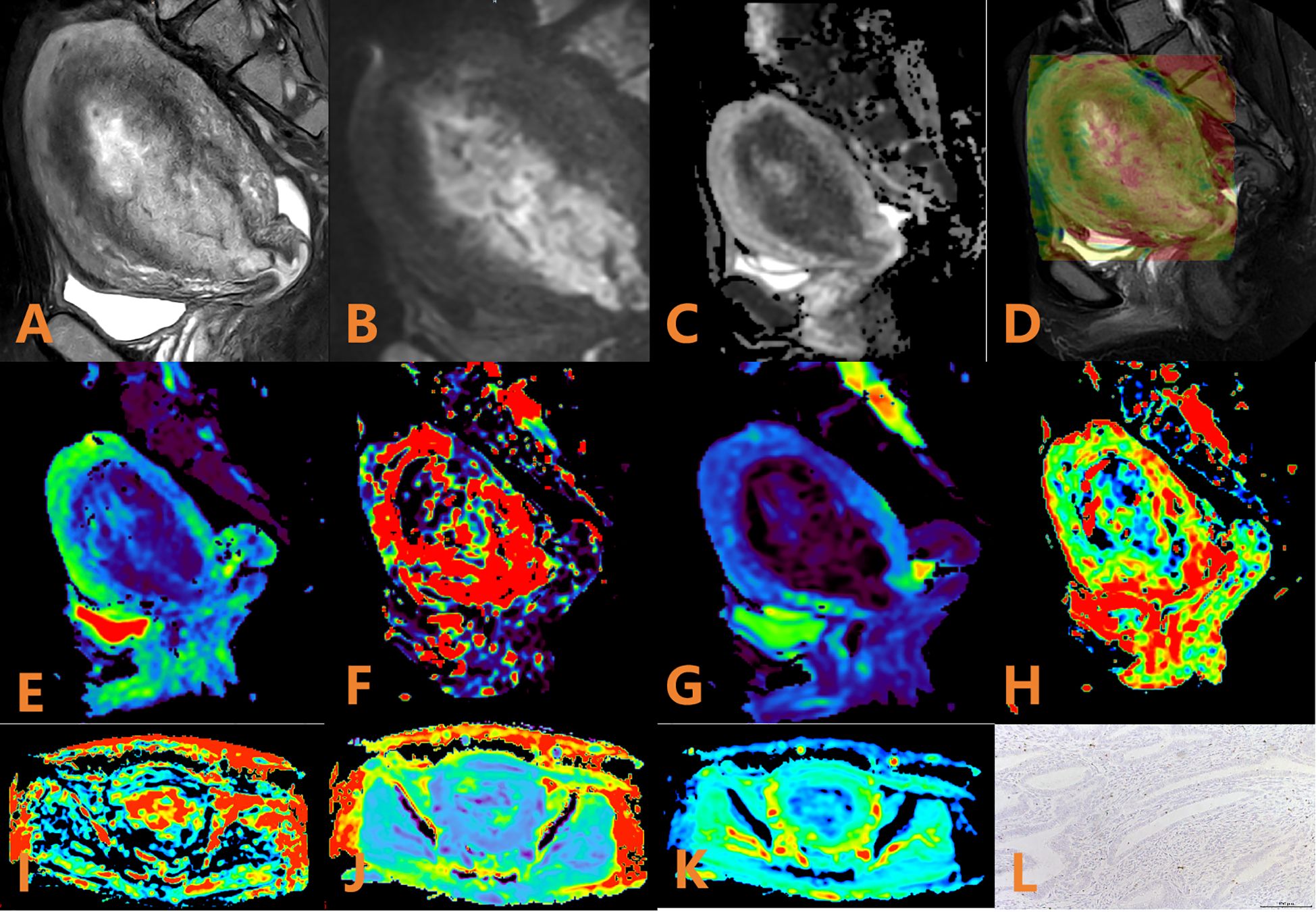 MRI and color-coded images of a heart, panels labeled A to L. A, B, C, D show gray scale MRI images with different contrast and detail levels. E, F, G, H, I, J, K display color-enhanced patterns highlighting areas of interest with hues ranging from blue to red. L is a zoomed-in view of tissue structure, possibly a histological section, showing cellular detail.
