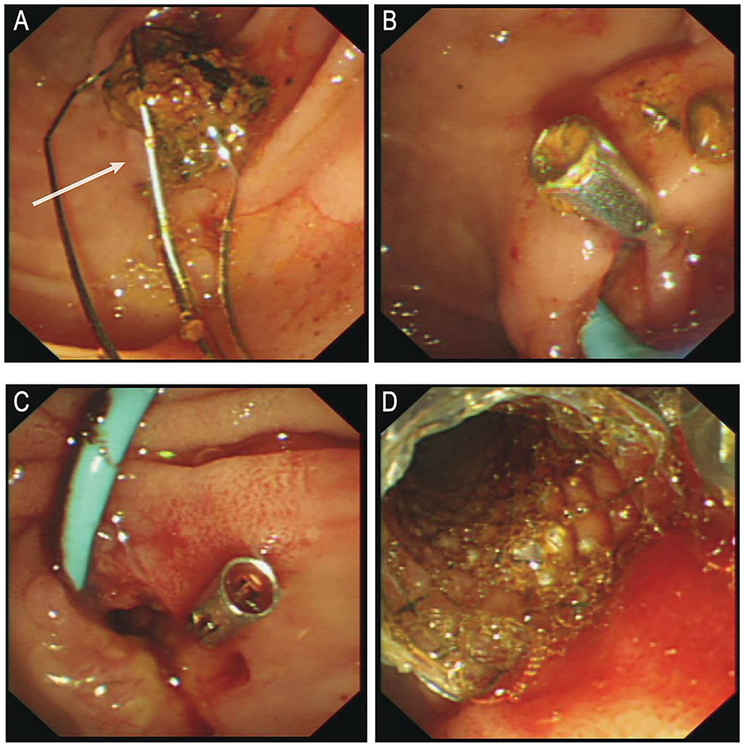 Four endoscopic images showing different stages of a procedure. Image A shows a tool with a wire and an arrow indicating a specific feature. Image B displays a foreign object embedded in tissue. Image C highlights a tool removing the object. Image D shows the area post-procedure, with visible tissue changes.