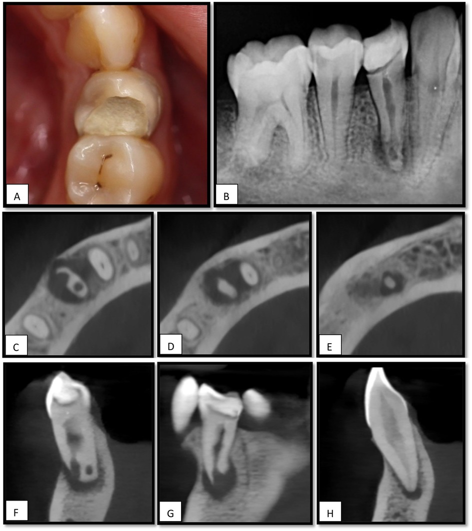 Image consisting of eight panels related to dental examination: Panel A shows a close-up of a decayed tooth. Panel B is a dental X-ray of molars. Panels C, D, and E display cross-sectional scans of teeth, likely from a CT scan. Panels F, G, and H provide side-view scans of individual teeth, highlighting root structures and cavities.