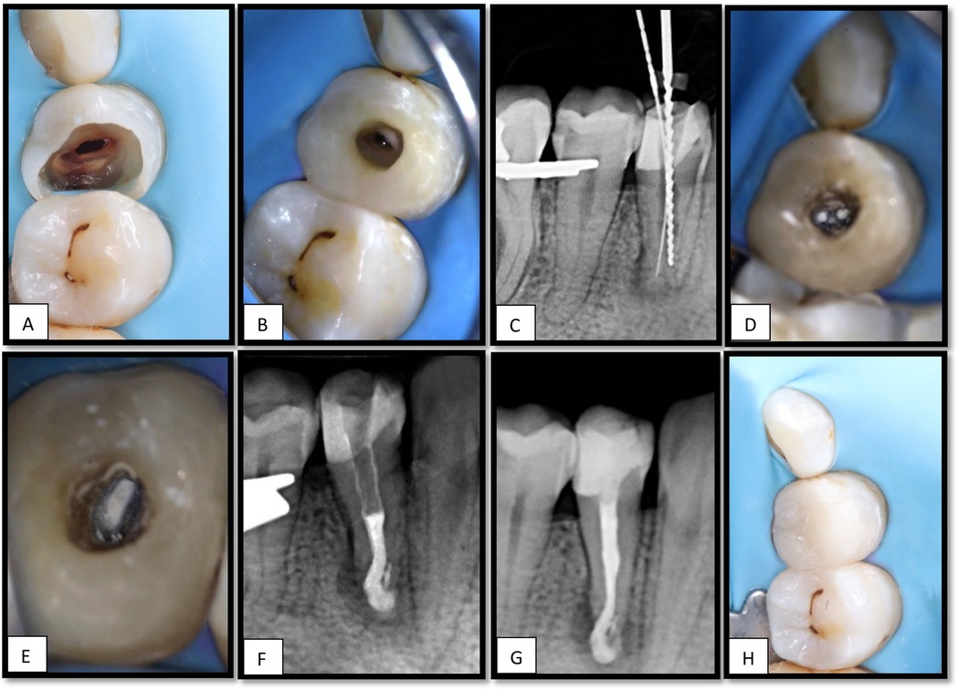 A series of images depicts various stages of dental treatment. A and B show initial tooth decay. C is an X-ray showing dental tools inside the tooth. D and E depict further treatment stages, with E showing a canal opening. F and G are X-rays displaying different views of the filled root canal. H shows the final restored tooth with fillings.