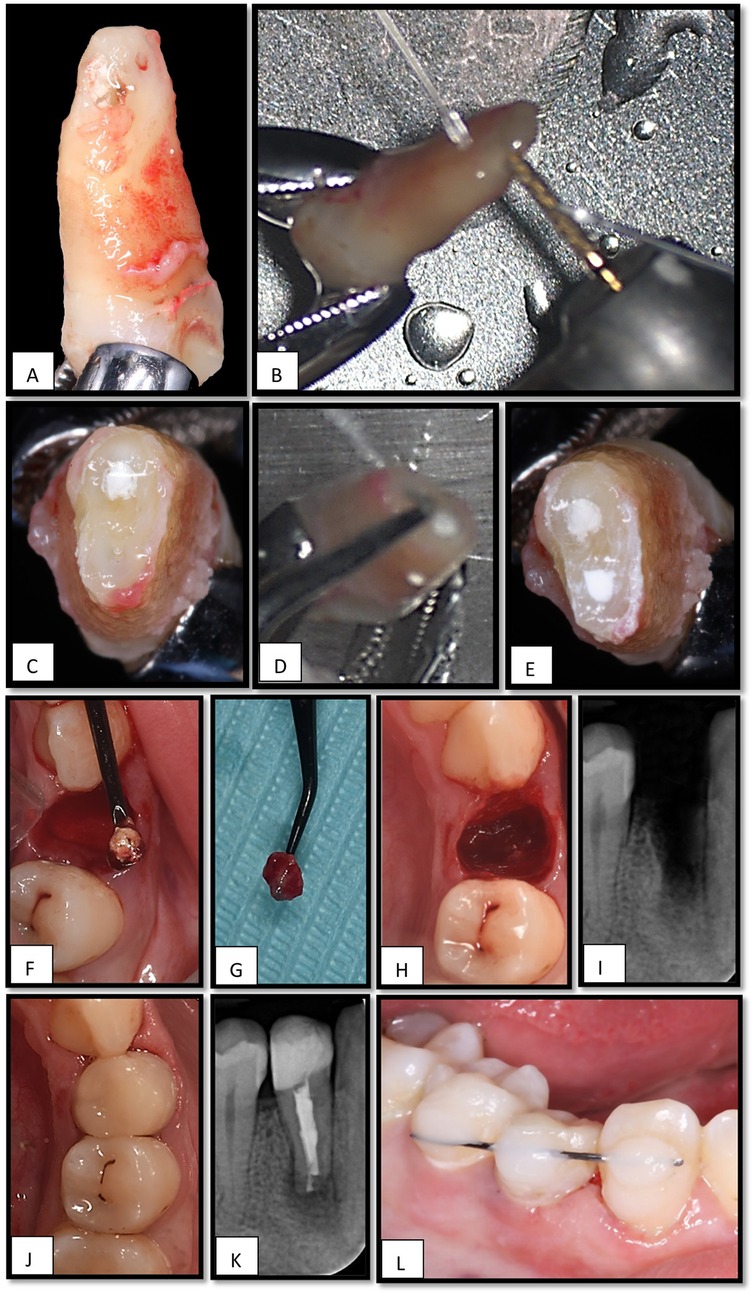 A series of dental procedure images: A) Extracted tooth with staining. B) Tooth with dental instrument. C) Prepared tooth with visible dentin. D) Root being treated. E) Tooth section showing cavity. F) Tooth with metal post being placed. G) Removed tissue fragment. H) Tooth cavity post-preparation. I) X-ray of tooth with a post. J) Final tooth restoration. K) X-ray showing tooth with post and restoration. L) Aligned restored teeth with dental wire.