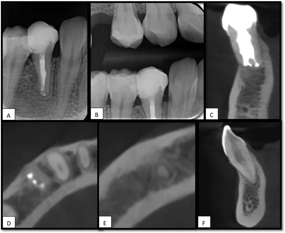 X-ray images of a dental procedure. Image A shows a side view of a tooth with filling. Image B shows a view of multiple teeth with fillings. Image C presents a longitudinal section of a filled tooth. Image D shows a cross-sectional view with metallic components. Image E displays a blurred section. Image F shows another longitudinal section with filling.
