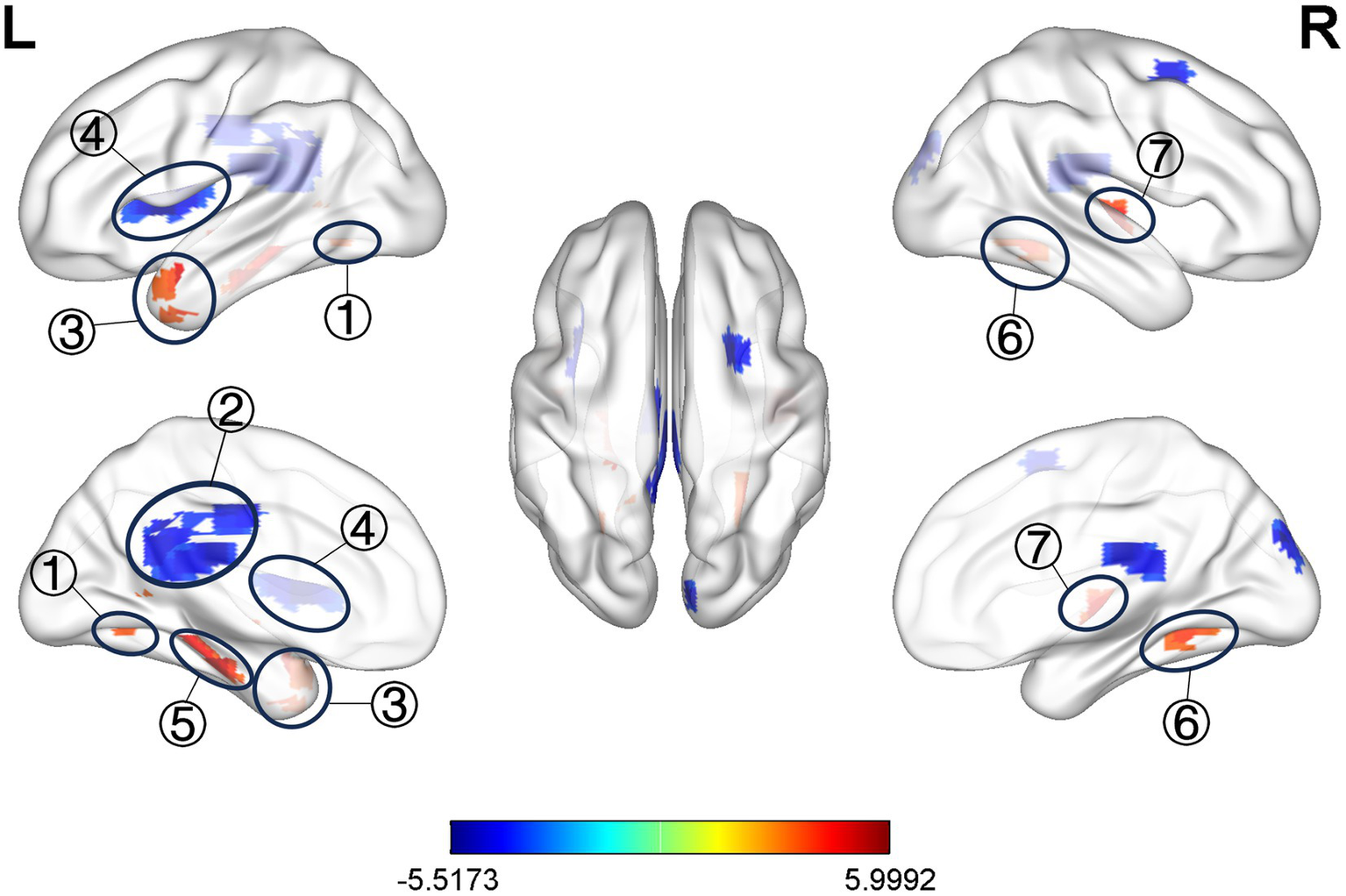 Brain activity visualization showing lateral and medial views of the left (L) and right (R) hemispheres. Marked regions are labeled and highlighted in blue and red, indicating varying intensity levels on a color scale from -5.5173 to 5.9992. Labels denote specific areas: L. PCUN, L. PCC, L. MTG, L. INS, L. HIP, R. PCUN, R. HIP.