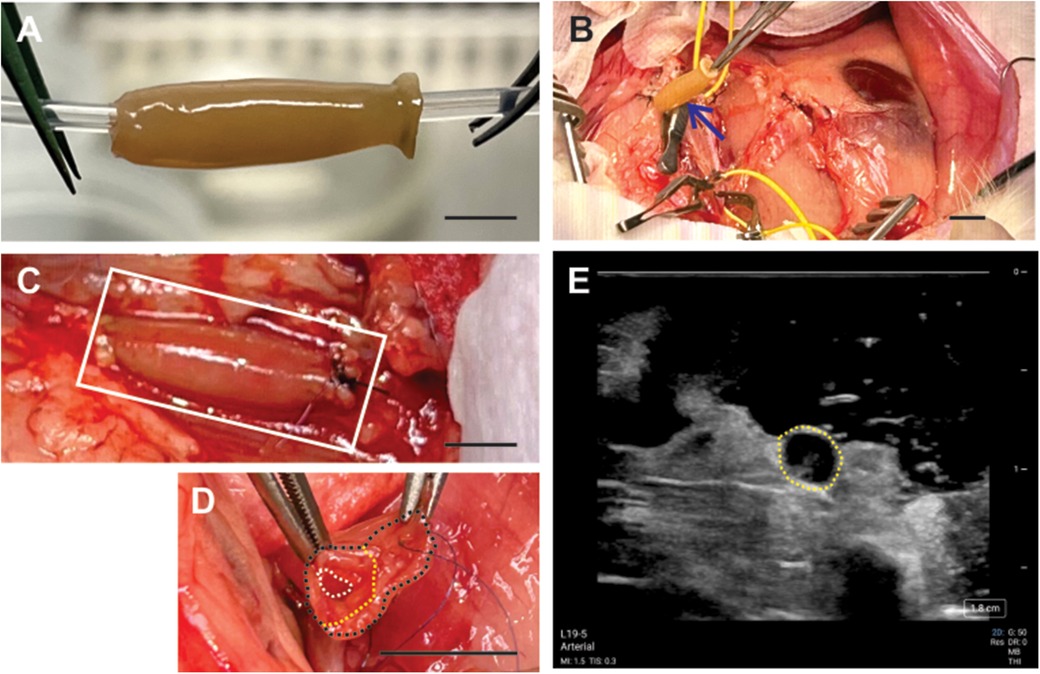 A series of images showing the stages of a surgical procedure involving a bioengineered blood vessel. Image A shows a close-up of the vessel held by forceps before implantation. Image B depicts the surgical site with the vessel being implanted. Image C is a close-up of the vessel sutured in place. Image D shows the vessel in cross-section, highlighting connections in dashed lines. Image E features an ultrasound image with a yellow outline indicating the vessel.