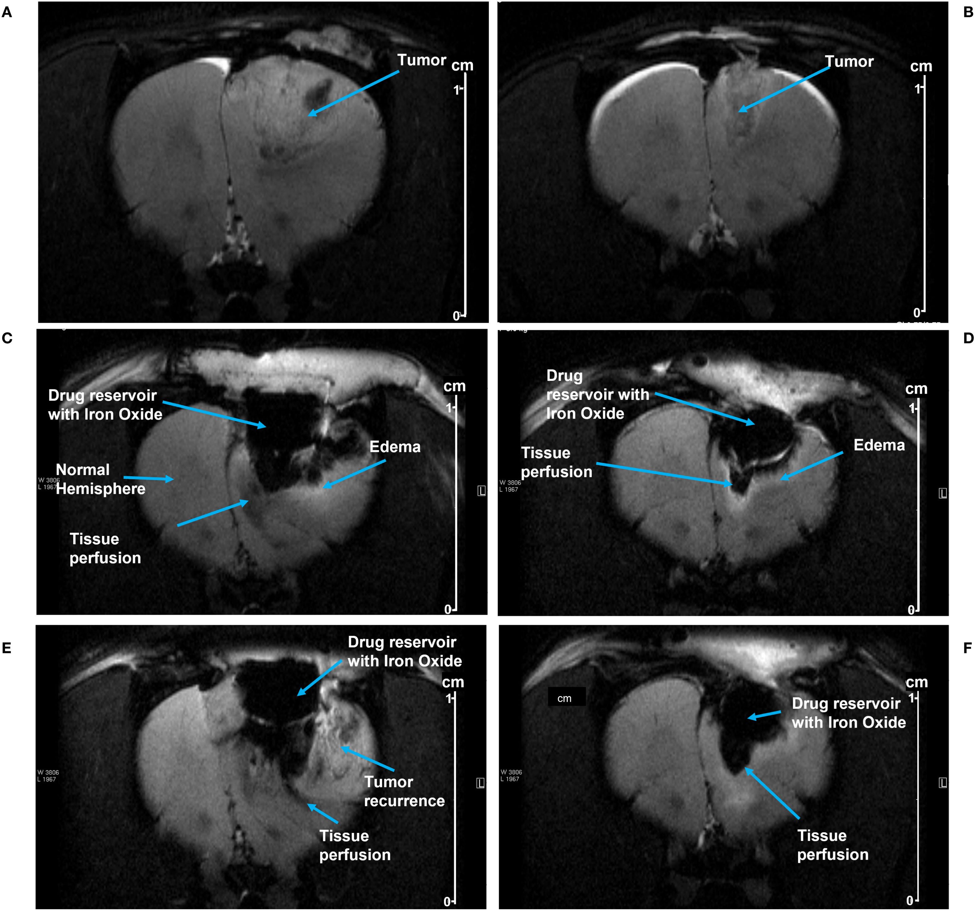MRI scans showing perfusion of iron oxide particles (SPIONS) into rat brain from implanted pumps. Images A and B show tumors in two different rats. Images C-F show SPION perfusion into the brain over several days, after excision of the tumor and implantation of the pump. Blue arrows label specific areas of interest, including drug reservoirs with SPIONS in the implanted pumps, tissue perfusion, edema, tumor recurrence, and normal hemispheres.