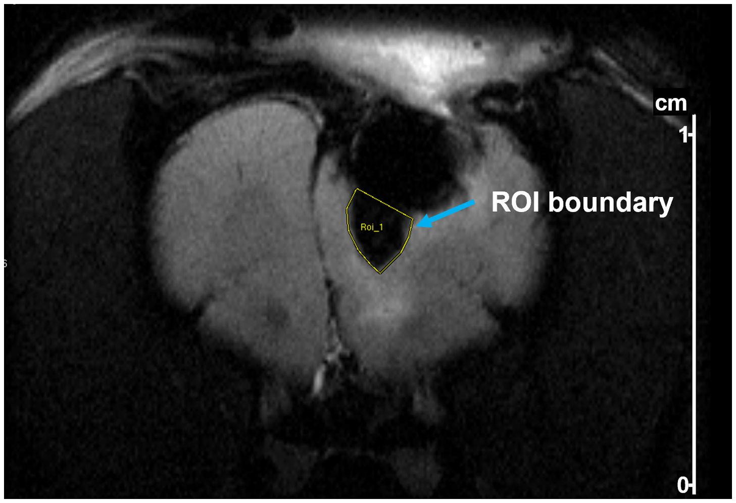 MRI scan showing a highlighted region of interest (ROI) labelled ROI_1 within the brain. This region corresponds to a region of SPION perfusion from an implanted pump. The boundary of the ROI is marked with a yellow outline, indicated by a blue arrow and label. The scale in centimeters is shown on the right.