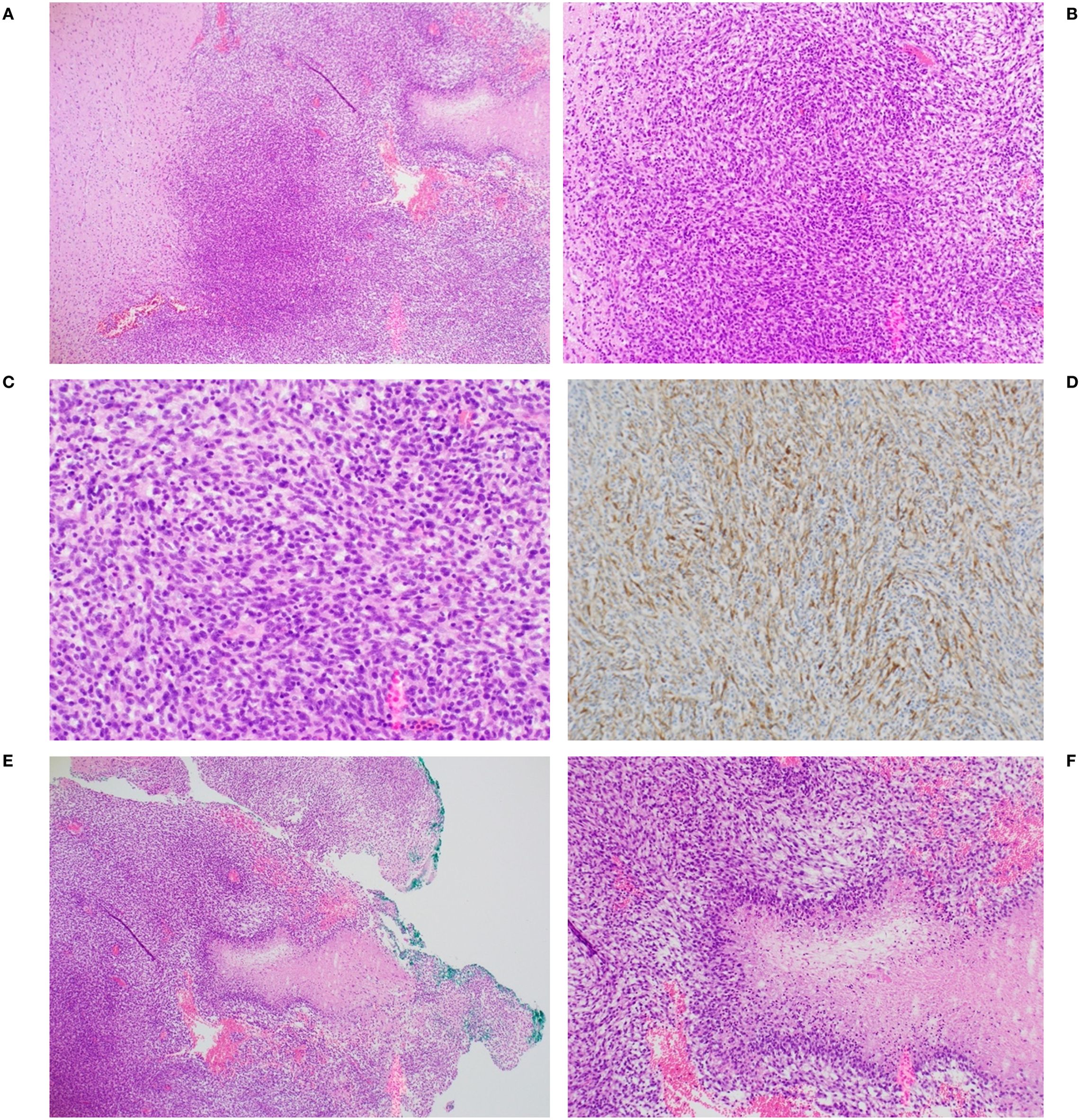 Histological images labelled A to F show different tissue samples from an excised C6 tumor. Images show various magnifications of tumor cells, highlighting aspects of tumor morphology. Images A, B, C, E, and F are stained purple with hematoxylin and eosin. Image D is blue and brown and is stained with antibodies to glial fibrillary acidic protein (GFAP).