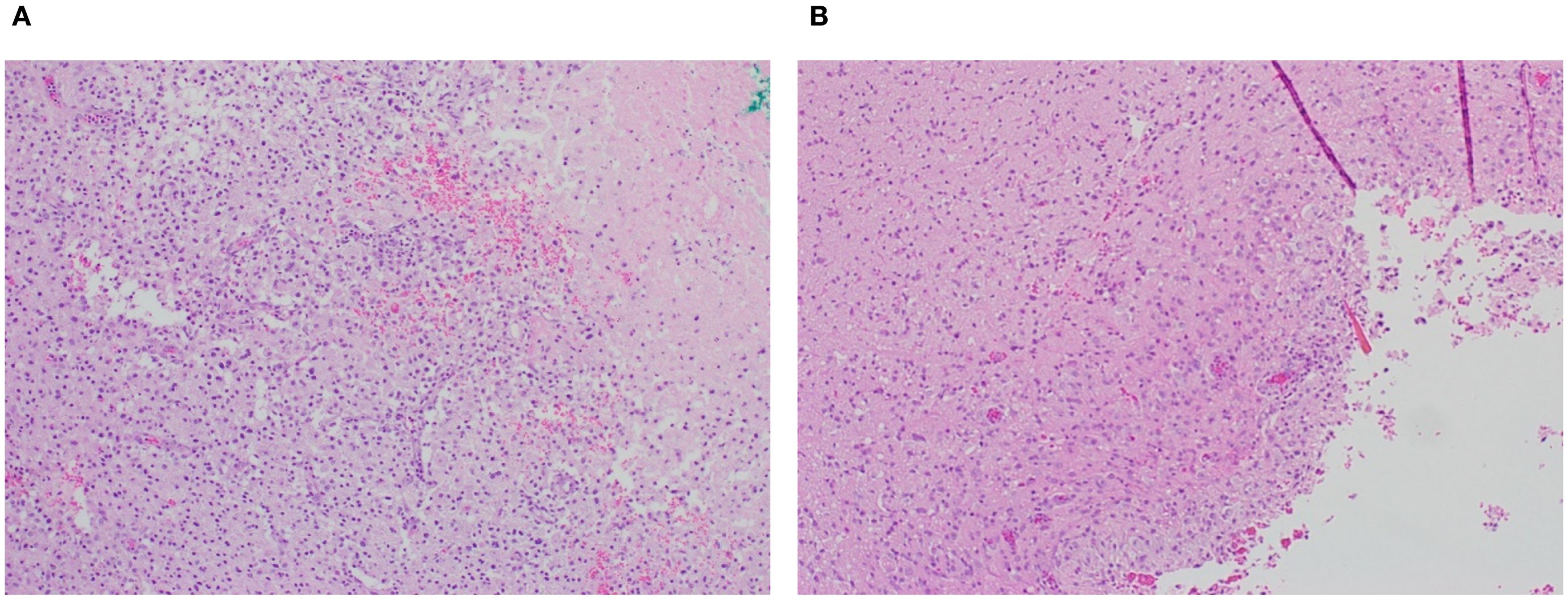 Histological comparison of post-resection cavities. Image A shows cavity after pump implantation. Image B shows cavity that had no pump implanted. Both images are stained with hematoxylin and eosin. The presence of macrophages and chronic inflammation seen in both images.