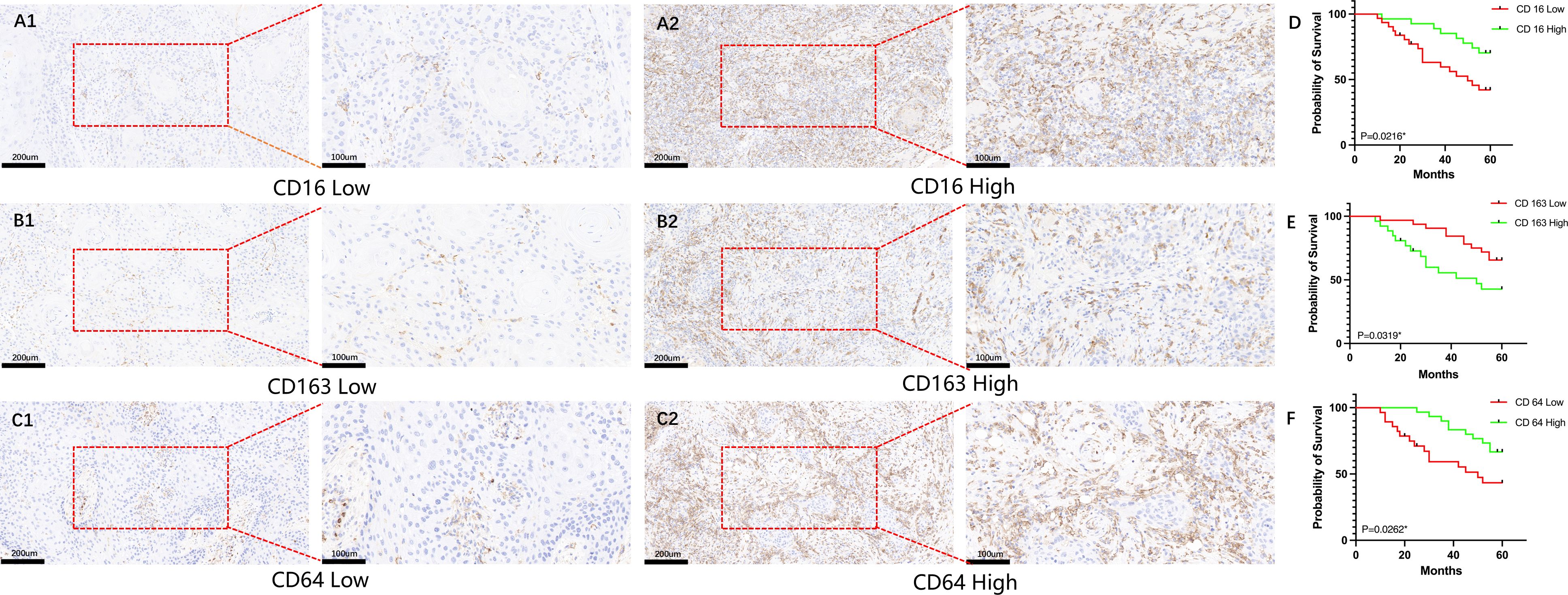 Microscopic images of tissue samples are shown in three rows with corresponding survival probability graphs. The top row compares CD16 Low and High expressions, the second row compares CD163 Low and High, and the third row compares CD64 Low and High expressions. Graphs on the right show survival probability over months with CD expressions marked as Low or High. Scale bars of 200 micrometers and 100 micrometers indicate magnification levels.