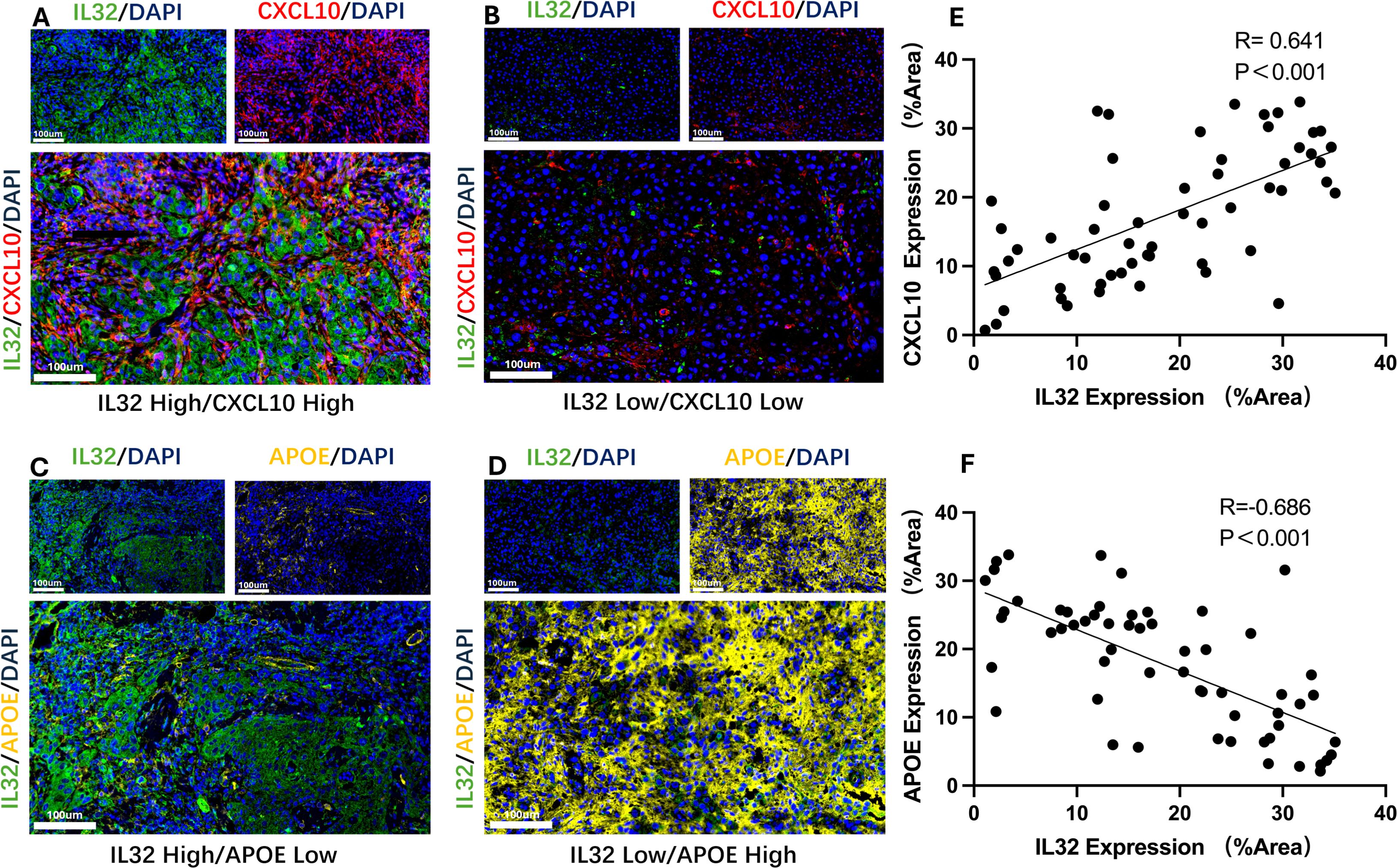 Panels A and B show tissue samples stained for IL32 and CXCL10, illustrating high and low expression levels. Panels C and D depict IL32 and APOE staining, indicating expression variations. Panel E displays a scatter plot with a positive correlation between IL32 and CXCL10 expression. Panel F shows a negative correlation between IL32 and APOE expression. Both plots indicate significant correlations with R and P values noted.