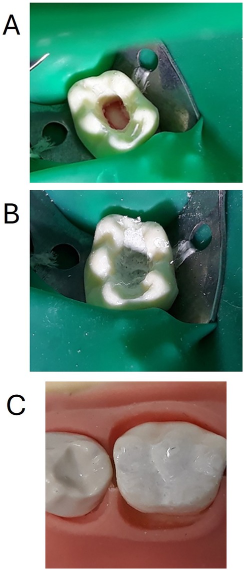 Panel A shows a tooth with an exposed cavity prepared for treatment, surrounded by a dental dam and metal clamp. Panel B displays the same tooth with a filled cavity. Panel C shows a pair of teeth with the filled tooth appearing natural beside an adjacent tooth.