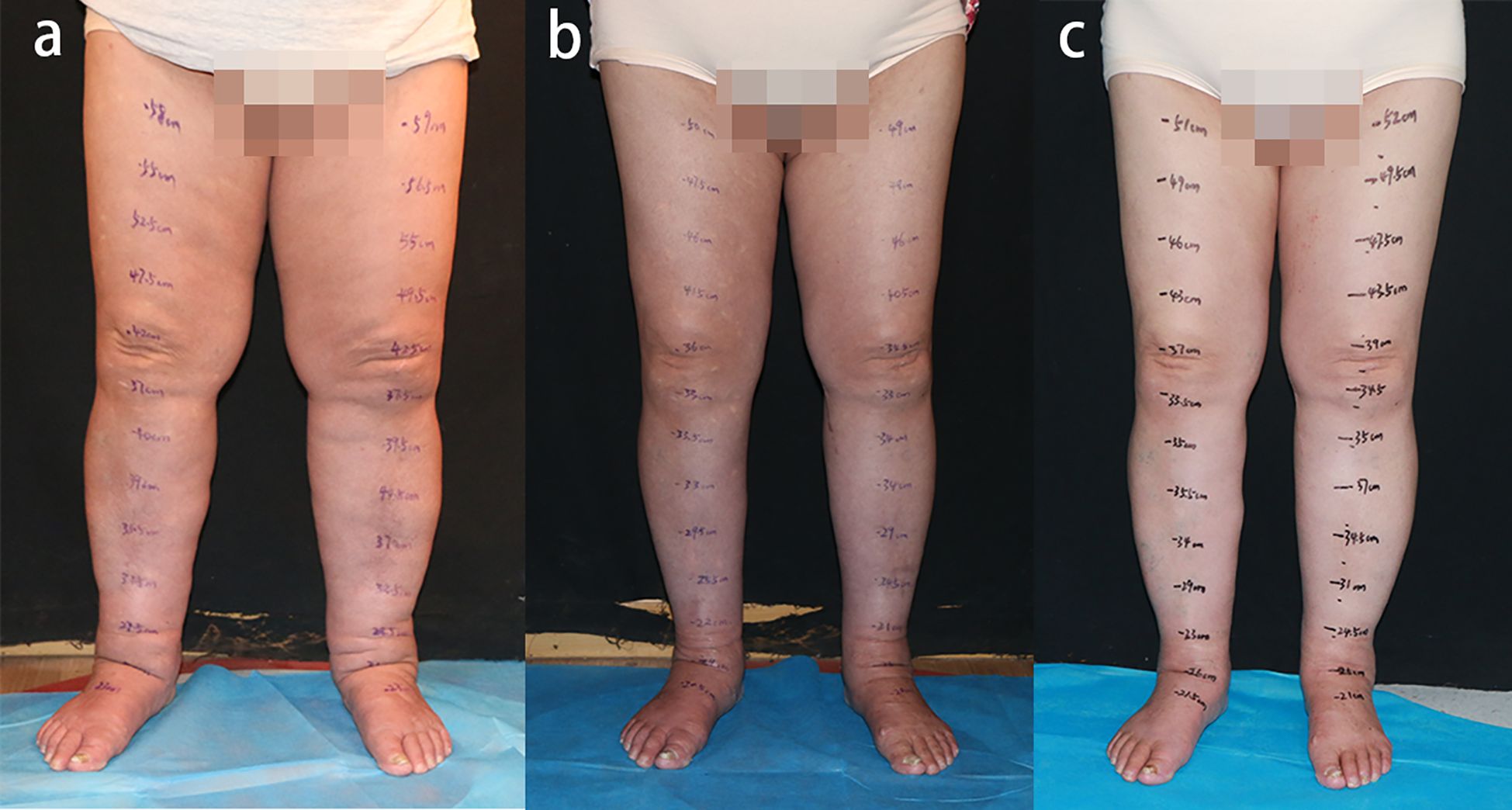 Three side-by-side images labeled a, b, and c show a person's legs with measurements written on the skin. The legs appear progressively slimmer from left to right. The person is standing on a blue sheet.
