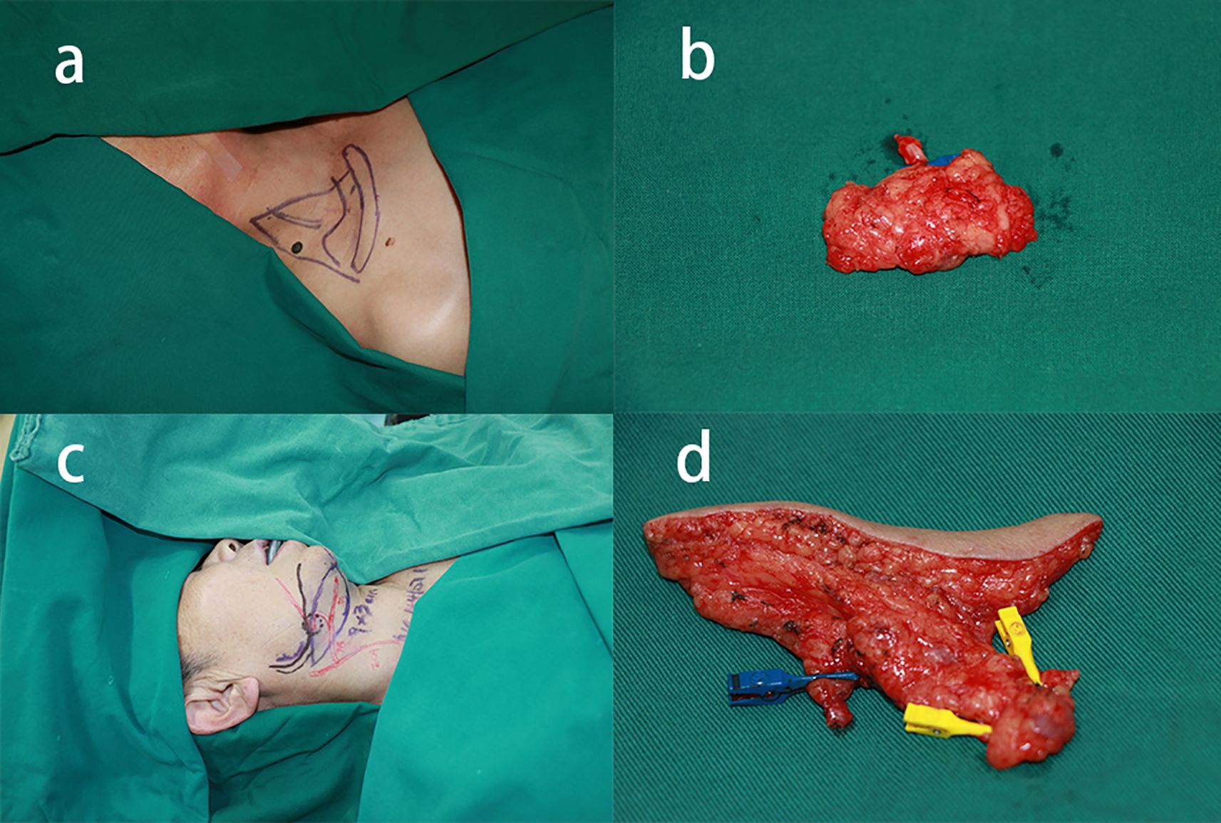 Medical procedure illustration showing four stages: a) Preoperative surgical markings on a patient’s neck. b) Excised tissue sample. c) Patient's profile with marked incision lines. d) Removed tissue with attached identifiers.