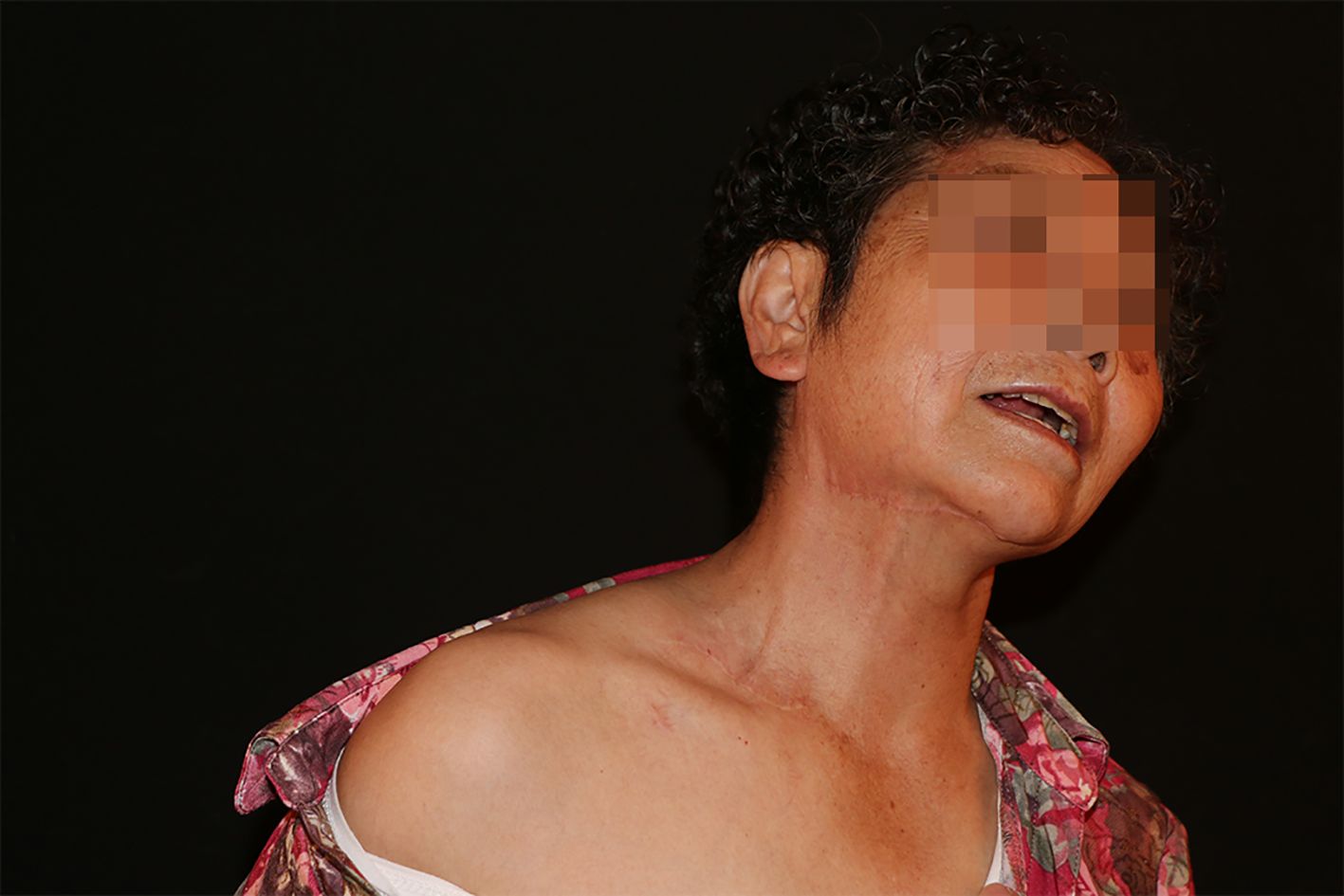 A person with pixelated facial features against a black background. They are wearing a pink patterned garment, partially off the shoulder, with visible skin marks on the neck and shoulder.