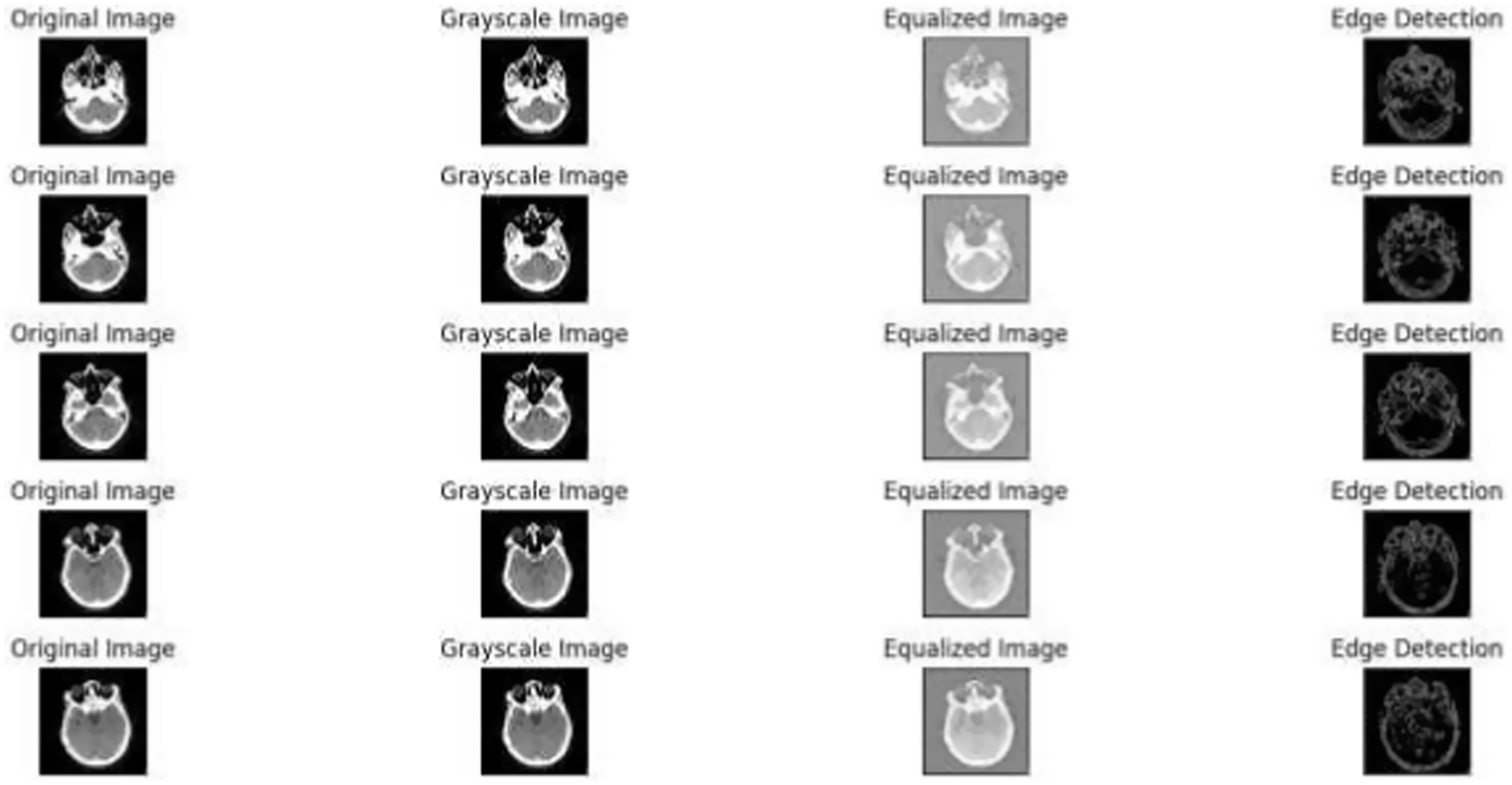 Four rows of medical images, each showing a progression through four stages: Original Image, Grayscale Image, Equalized Image, and Edge Detection. Each stage visually modifies the same medical scan.