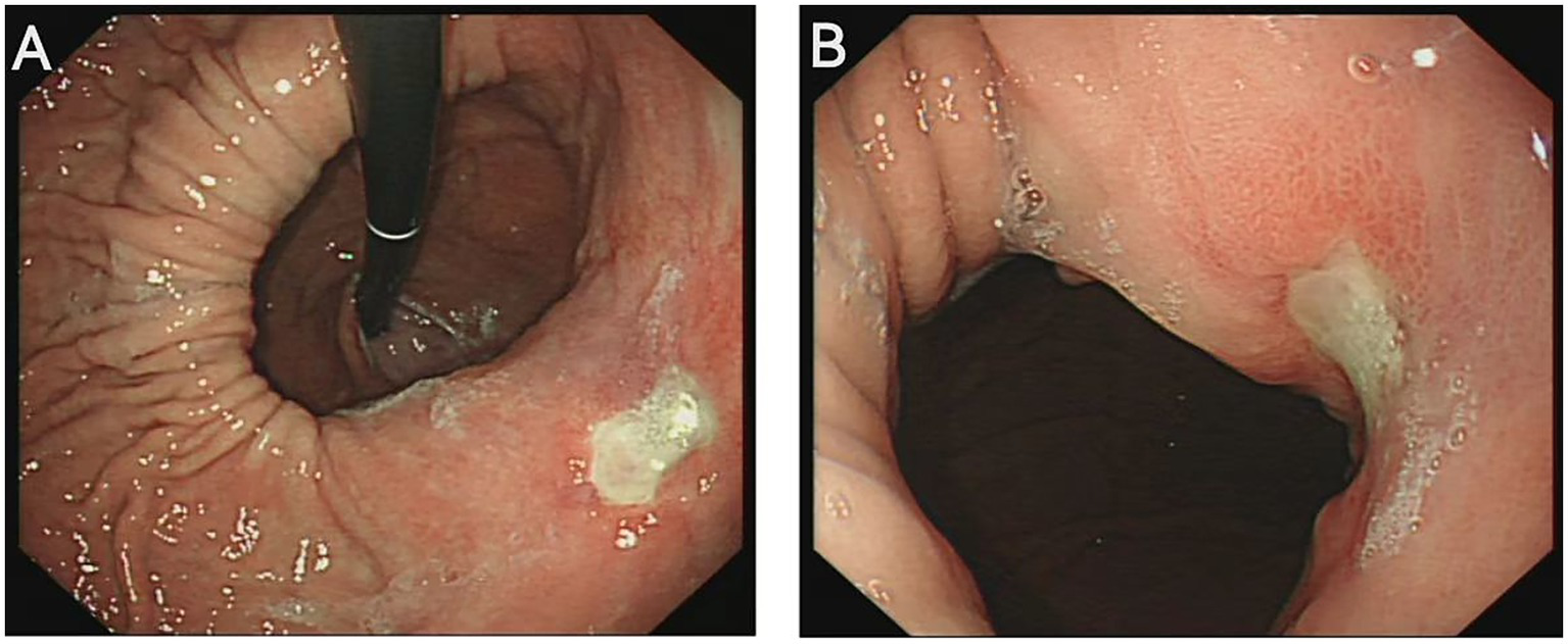 Endoscopic images of the esophagus are shown. Image A displays a segment of the esophagus with a protruding lesion near the endoscope. Image B shows another section with inflamed, reddened tissue and a visible ulceration.