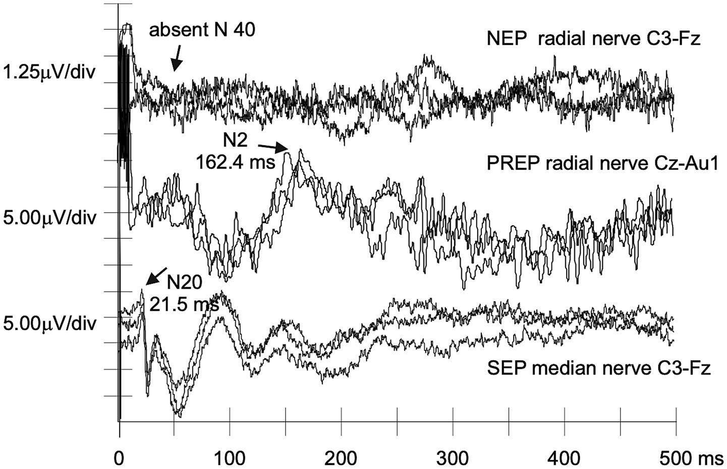 Graphs showing neurophysiological recordings from a patient with ATTRv-PN. The top trace shows nociceptive evoked potentials (NEPs) recorded at C3–Fz after stimulation of the dorsum of the dominant hand, highlighting an absent N40. The middle trace shows painrelatedevoked potentials (PREPs) recorded at Cz–Au1 after stimulation of the dorsum of the dominant hand, with an N2 at 162.4 ms. The bottom trace shows somatosensory evoked potentials (SEPs) recorded at C3–Fz after stimulation of the median nerve at the wrist, with an N20 at 21.5 ms. Each trace is scaled in microvolts per division over a 500-ms epoch.