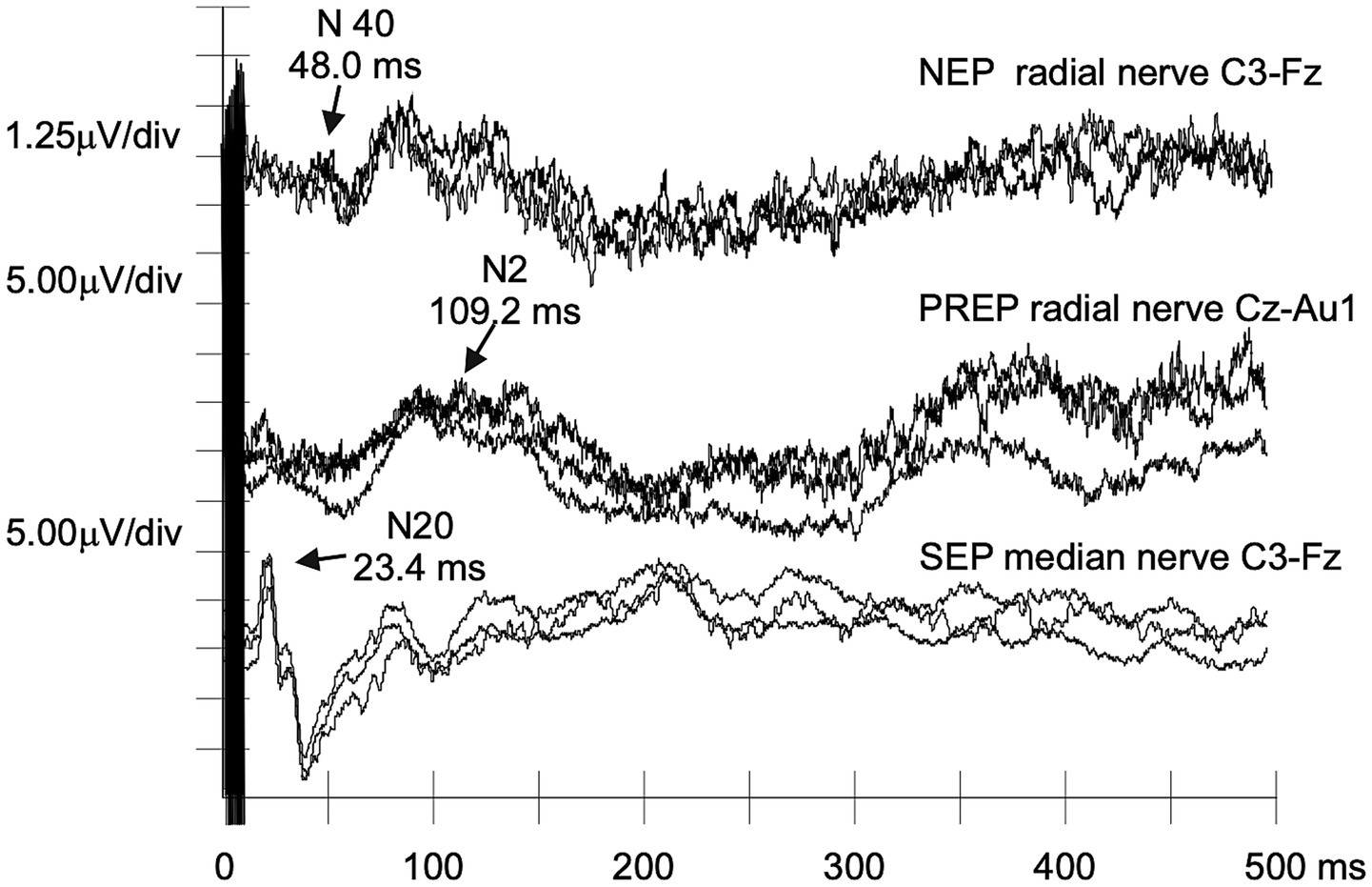 Graph showing nociceptive (NEPs), pain-related (PREPs), and somatosensory evoked potentials (SEPs) recorded from an asymptomatic TTR variant carrier. The N40 (NEPs) was recorded at C3-Fz with a latency of 48.0 ms; the N2 (PREPs) was recorded at Cz-Au1 with a latency of 109.2 ms; and the N20 (SEPs) was recorded at C3-Fz with a latency of 23.4 ms. The vertical axis shows microvolts per division, and the horizontal axis shows time in milliseconds.