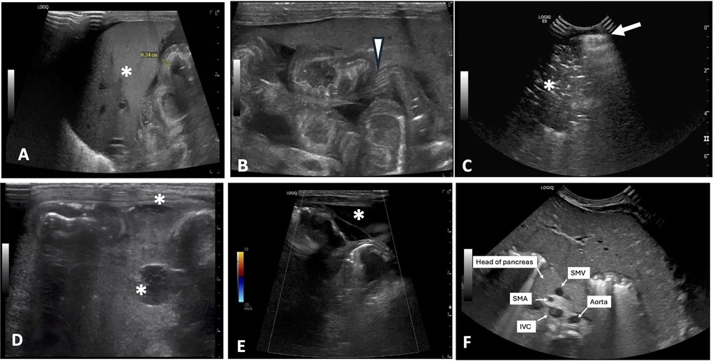 Six-panel image displaying ultrasound scans of the abdomen. Each panel shows a different view or aspect with markers like asterisks, arrows, and notations such as \