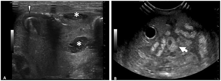 Ultrasound images labeled A and B. In image A, a transverse neck view shows two anechoic areas marked by asterisks and a calcified nodule indicated by an arrowhead. Image B reveals a transverse view of the thyroid gland with multiple hyperechoic and hypoechoic patterns; a large hypoechoic nodule is marked with an arrow. Black, white, and grayscale bars are visible, indicating ultrasound parameters.