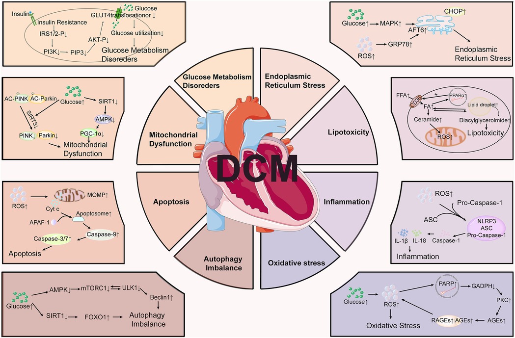 Diagram illustrating the various pathological factors contributing to Diabetic Cardiomyopathy (DCM). Central illustration of a heart surrounded by sections labeled Glucose Metabolism Disorders, Mitochondrial Dysfunction, Endoplasmic Reticulum Stress, Lipotoxicity, Inflammation, Apoptosis, Autophagy Imbalance, and Oxidative Stress. Each section details the molecular pathways and components involved, such as insulin resistance, ROS increase, and apoptosis markers, showcasing complex interactions leading to DCM.