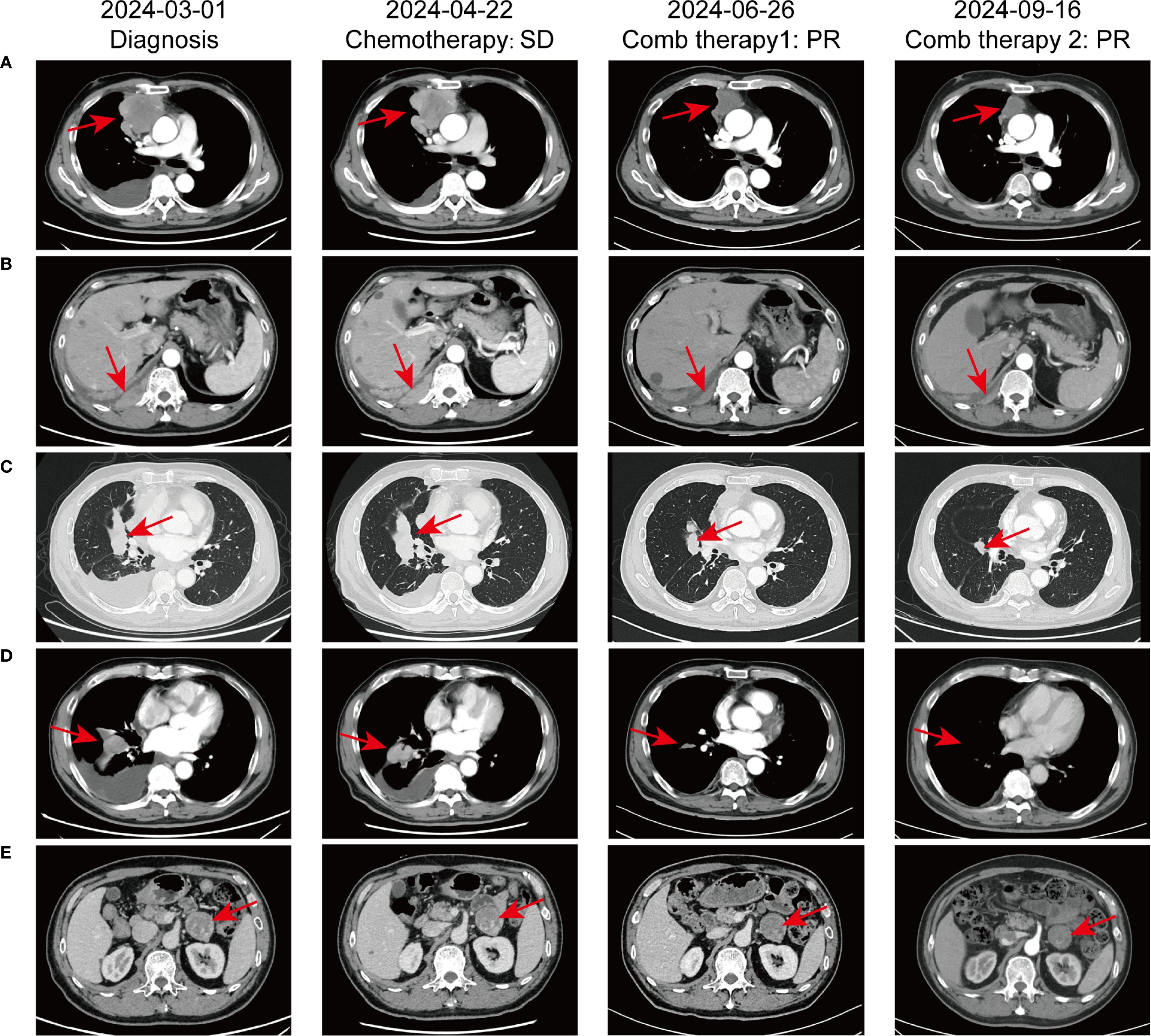 CT scan series showing five rows labeled A to E and four columns with dates and treatment stages: Diagnosis, Chemotherapy, Combination Therapy 1, and Combination Therapy 2. Red arrows indicate areas of interest in each scan.
