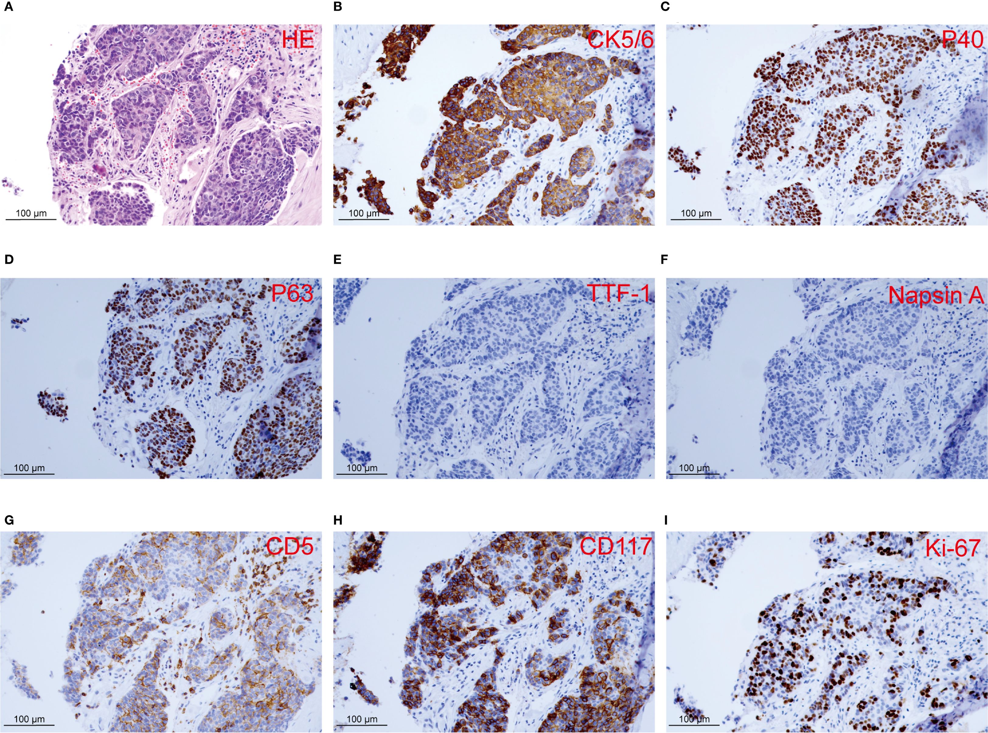 Histological images of tissue samples labeled with different stains or markers. Image A shows H&E staining, B shows CK5/6, C shows P40, D shows P63, E shows TTF-1, F shows Napsin A, G shows CD5, H shows CD117, and I shows Ki-67. Each image displays cellular structures within 100 micrometer scale bars.