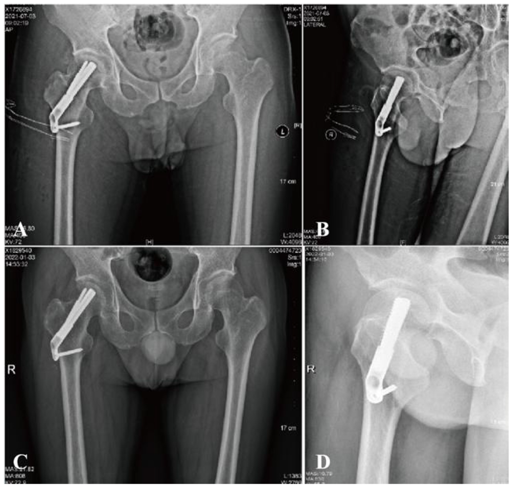 X-ray images of a hip joint showing an orthopedic implant. Panel A and C display the anterior-posterior view with the implant in the left hip. Panel B and D show lateral views, illustrating the implant's alignment with the femur. All images indicate the presence of surgical hardware.