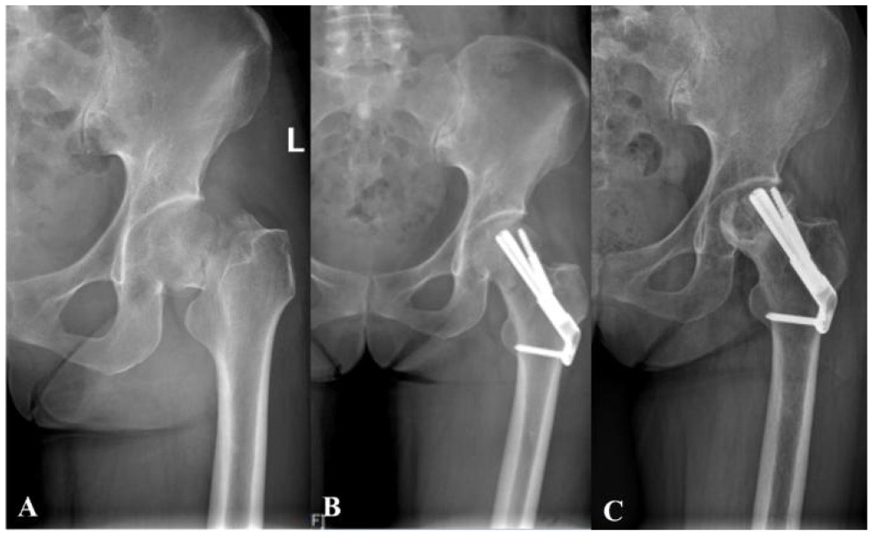 Three X-ray images labeled A, B, and C, showing the pelvis and upper femur. Image A displays a normal hip joint. Images B and C show a hip with surgical screws inserted, indicating a procedure to stabilize a fracture.