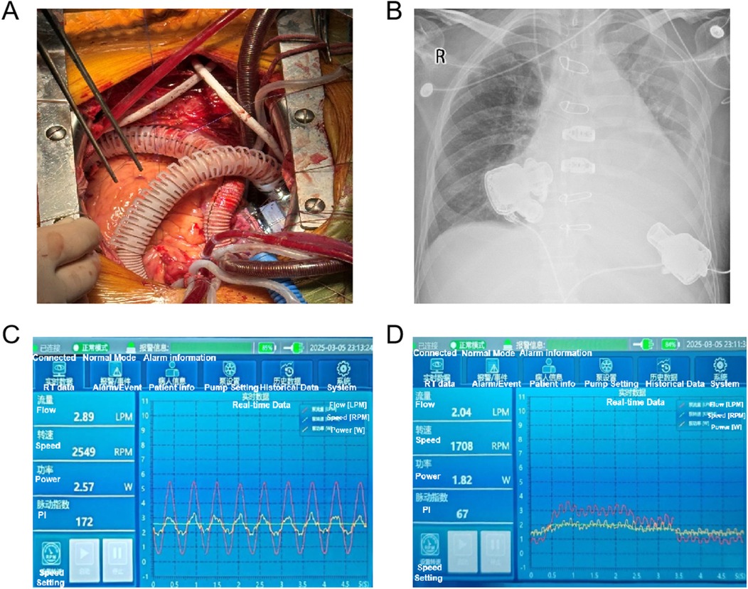 A: Surgical view of a heart with medical tubes and equipment attached during an operation. B: X-ray image showing the chest area with medical implants visible. C: Medical monitor displaying real-time data with flow, speed, and power metrics, featuring a chart with wave patterns. D: Another medical monitor screen showing similar metrics with different values and a chart displaying data trends.