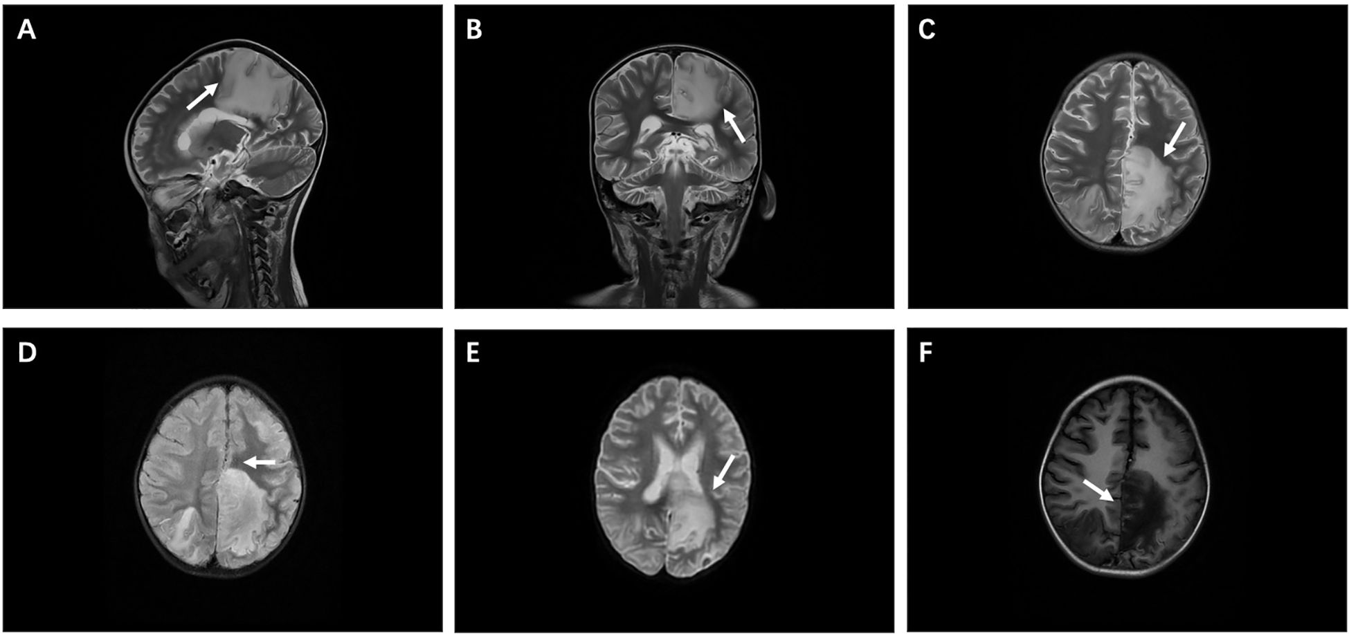 MRI brain scans labeled A-F show cross-sectional images with arrows pointing to specific regions of interest. Panels A and B depict sagittal and coronal views, respectively, highlighting a notable area in the left hemisphere. C, D, E, and F show axial views with arrows emphasizing similar regions across the sections.