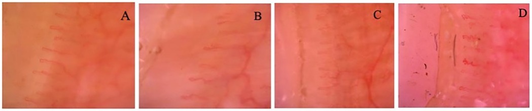 Panels A, B, C, and D display nailfold capillaroscopy images obtained at 200× magnification. The images show the distal row of capillaries with visible loops, demonstrating differences in capillary morphology between groups. Variations in capillary density, dilatation, tortuosity, and architectural organization are observable across the panels. Background is pale, with red capillary loops contrasting against the surrounding tissue. These images illustrate representative morphological patterns used for quantitative and qualitative assessments.