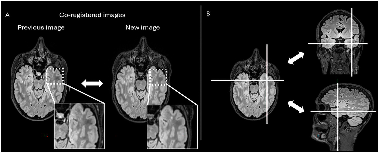 MRI comparison showcasing co-registered images with two axial views labeled as “Previous image” and “New image” on the left, representing a reading environment in Jazz® software. Magnified regions highlight differences. On the right, a lesion-locking option is represented as the three orthogonal MRI sections of the brain with crosshairs indicating lesion's location.