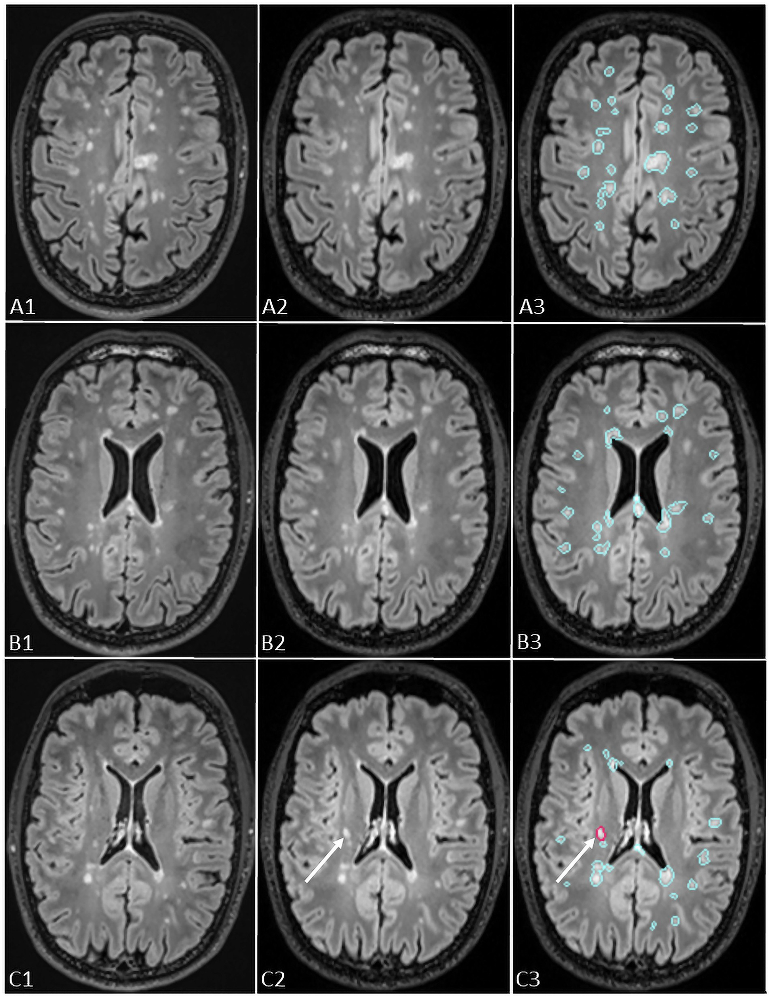 A set of axial slices of brain MRIs in three different levels is presented, where first column (1) represents previous exam, middle column (2) new exam and last column (3) segmentation mask provided by Pixyl.Neuro.MS®, representing a lingitudinal evaluacion of previous and new FLAIR images. In each slice there can be identified high number of MS lesions. Lesions in the third column (3) are segmented and color-coded based on their temporal evolution, where blue color represents stable lesion, and red color new lesion. The new lesion detected using Pixyl.Neuro.MS® is indicated by an arrow in C3, and confirmed by comparison of new (C2) and previous (C1) exams.