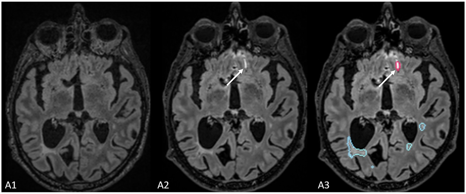 Three MRI brain scans labeled A1, A2, and A3. A1 show axial FLAIR images of previous (A1), new (A2) image, and a segmentation mask provided by Pixyl.Neuro.MS® A white arrow highlights a region that was detected by the software and classified as new lesion, however, the segmented region represents an artifact at the interface of brain parenchima and CSF.