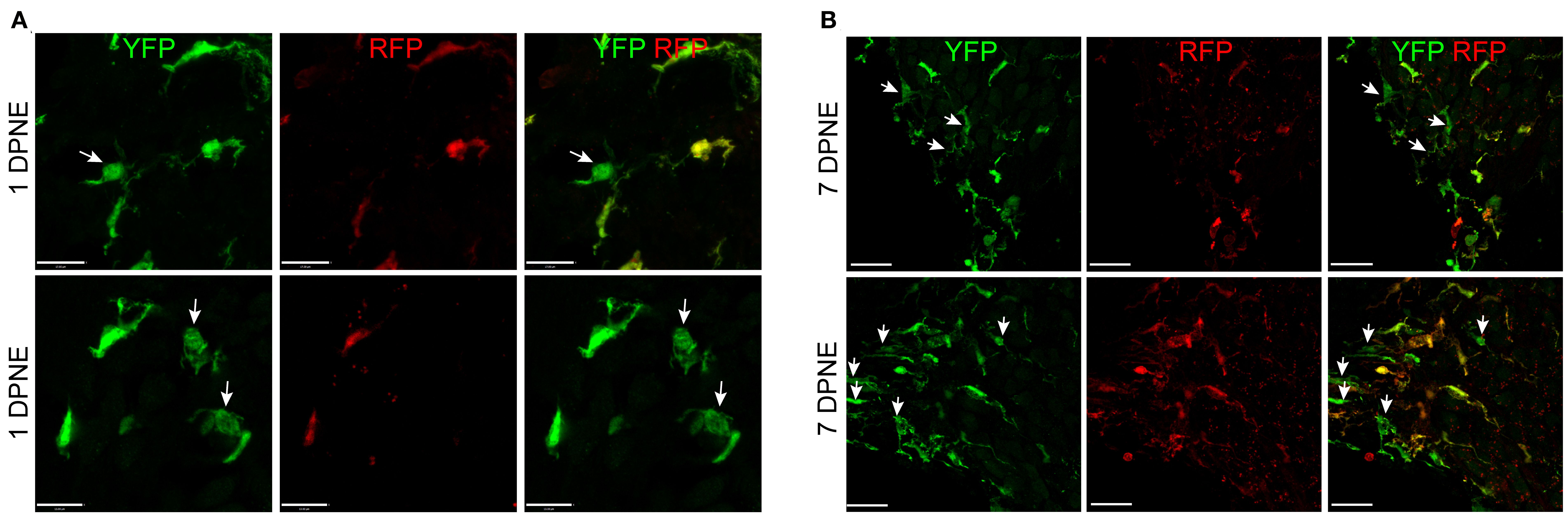 Morphology of CX3CR1-expressing resident macrophages (RM) and monocytes and monocyte-derived macrophages (Mo/Mo-M). Representative confocal micrographs showing indistinguishable morphology of CX3CR1-expressing resident (YFP+ RFP+) and recruited (YFP+ RFP−, white arrows) macrophages in the spiral ganglion at 1 (A) and 7 (B) days post-noise exposure. The recruited circulating Mo were transformed from being round or less ramified at 1 DPNE to more ramified by 7 DPNE (white arrows). This suggests that the infiltrated circulating Mo may differentiate into cochlear RM. Scale bars = 17 μm (top panel) and 13 μm (bottom panel) in (A) and 20 μm in (B).