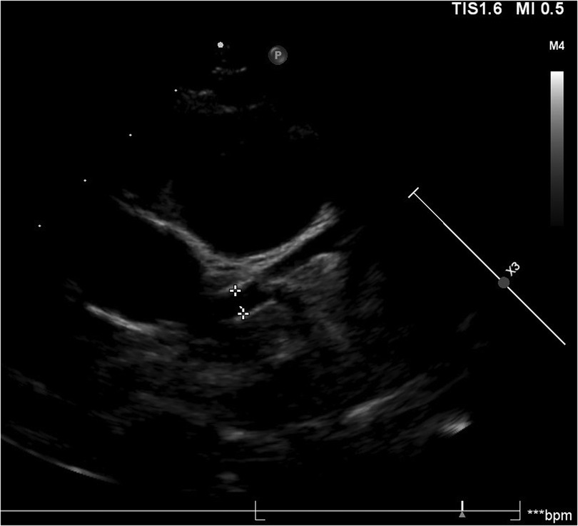 Ultrasound image showing a cross-sectional view of the heart with two prominent chambers visible. Measurement markers and annotations are present, including a scale bar and indicators labeled \