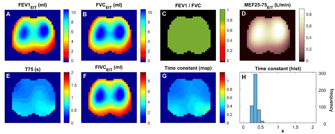 Grid of eight images displaying respiratory system data through color maps and a histogram. Images A, B, F, and G depict readings in milliliters using color gradients from blue to red. Image C shows FEV1/FVC ratio in green. Image D presents MEF25-75 data in shades from light to dark. Image E shows T75 values in blue. Image H is a histogram with frequency on the y-axis and “s” on the x-axis, displaying data distribution.