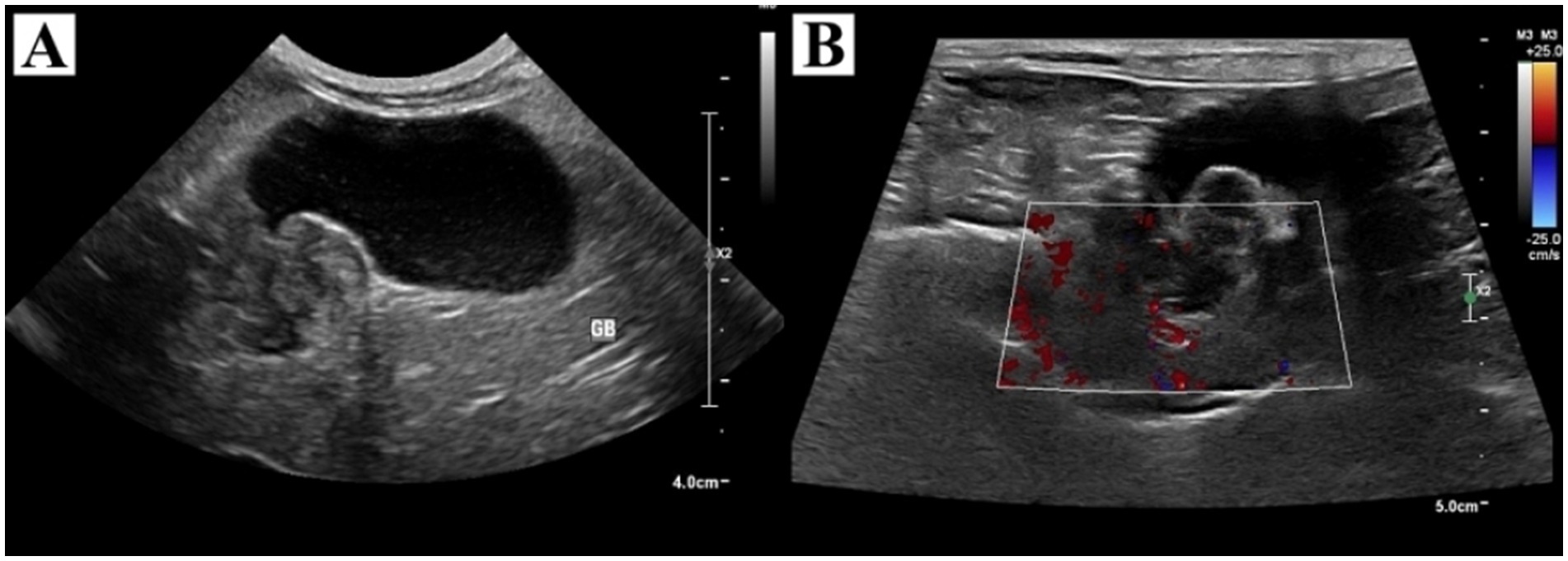 Ultrasound image with two panels. Panel A shows a grayscale ultrasound of the gallbladder labeled