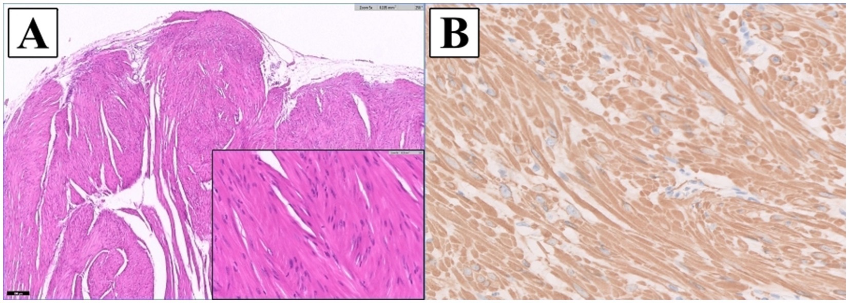 Panel A shows a microscopic image of a fibrous tissue section stained pink and purple, with varying fiber patterns. An inset highlights elongated spindle-shaped cells. Panel B displays a tissue section with a brownish stain, indicating a different cellular composition, with round and elongated cells.