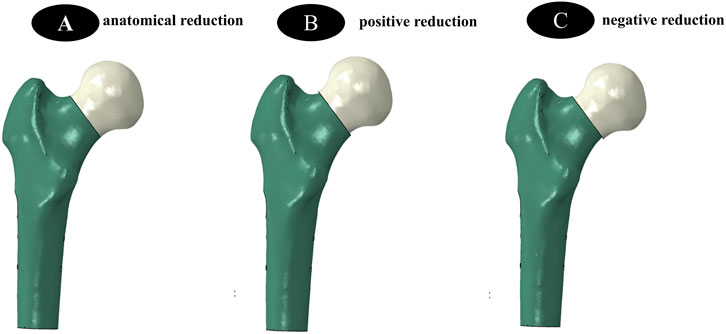 Three illustrations of femur head reductions are shown. A: Anatomical reduction with proper alignment. B: Positive reduction with the femoral head shifted upward. C: Negative reduction with the femoral head shifted downward.