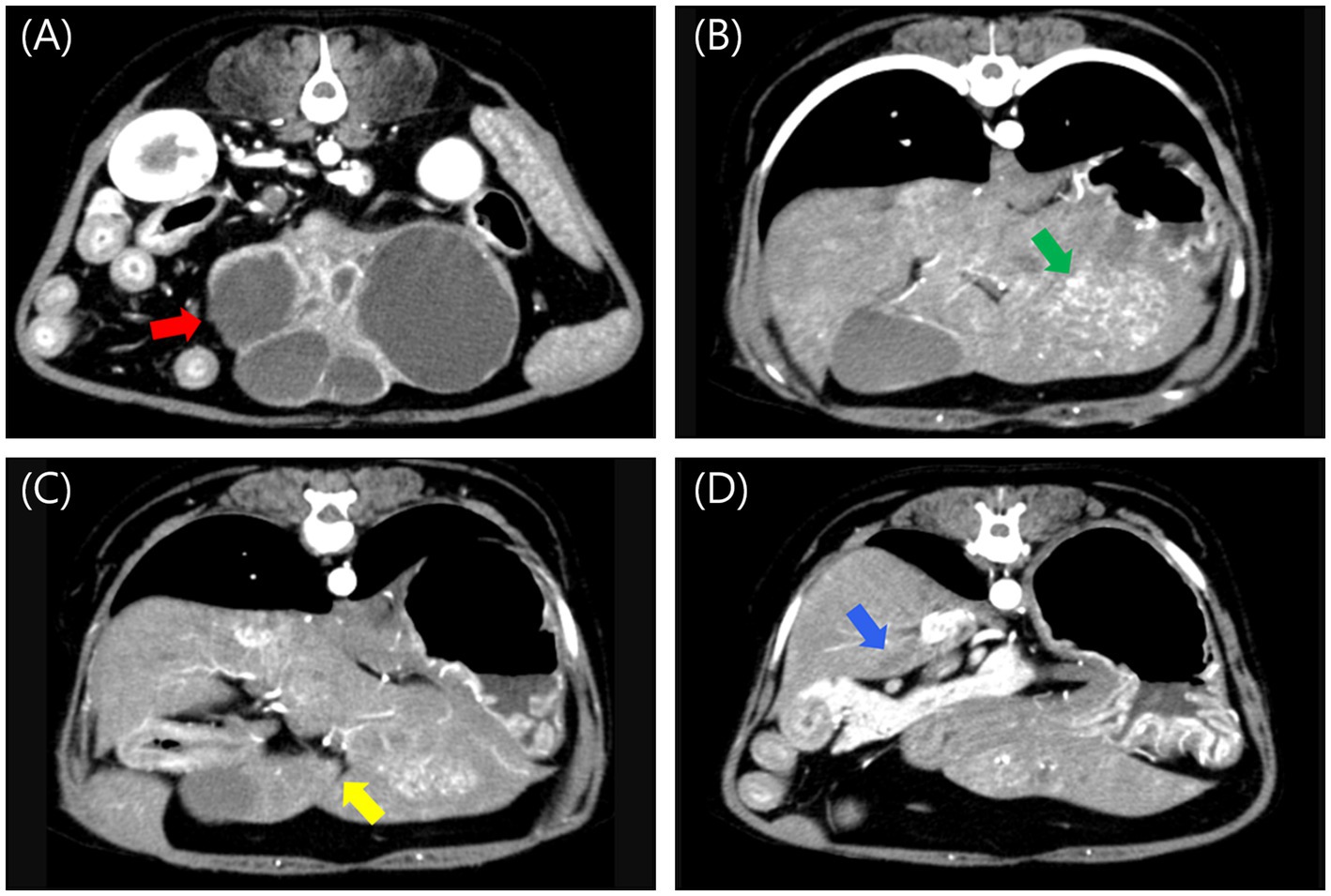CT scan images labeled A to D show different sections of abdominal organs. Image A highlights a region with a red arrow, image B a green arrow, image C a yellow arrow, and image D a blue arrow, each indicating specific areas of interest in the organs, likely highlighting abnormalities or focal points for diagnosis.