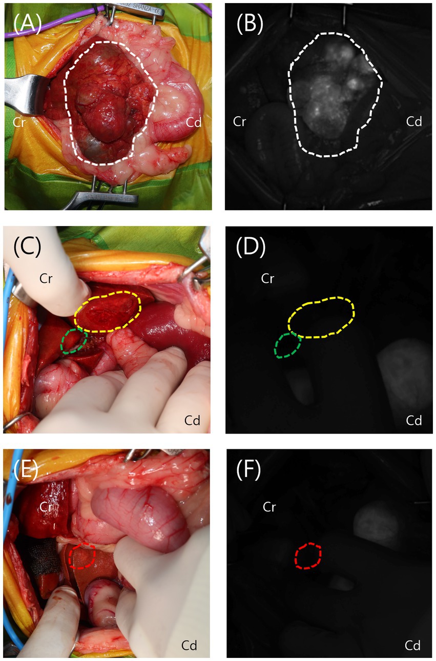 A multi-panel image features surgical fields with annotations. Panel A shows a color image with a dashed white outline highlighting an area, labeled Cr and Cd. Panel B displays the same in monochrome. Panel C, a color image, has a yellow outline over a section, near a green outline. Panel D mirrors C in monochrome. Panel E, again in color, contains a red outline around a small area. Panel F replicates E in monochrome. Hands and surgical equipment are visible in several panels.