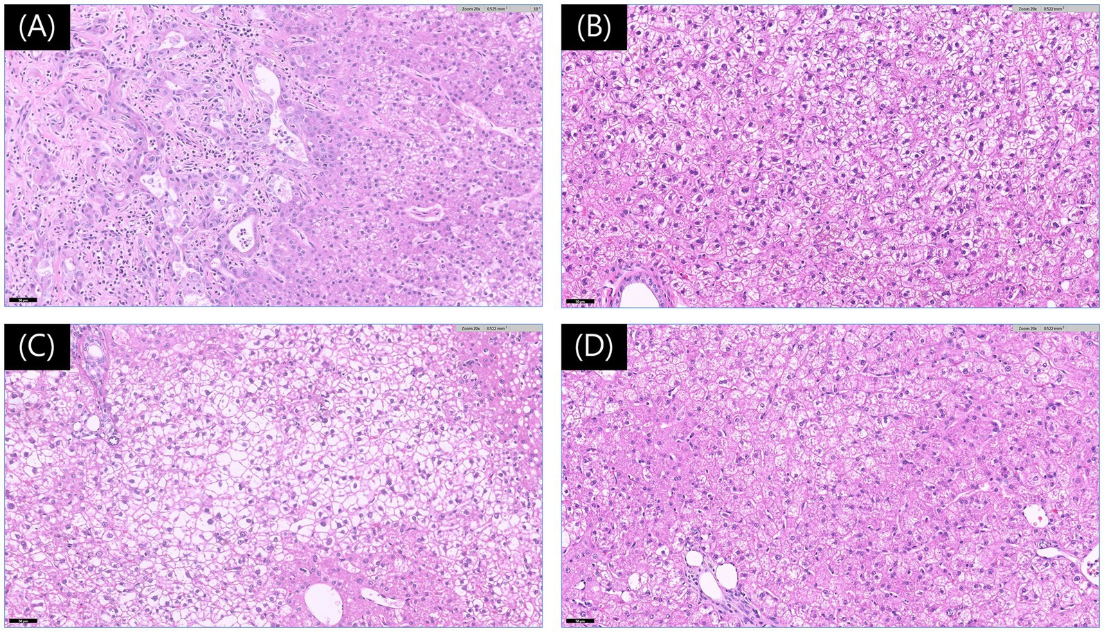 Histopathological images of liver lesions stained with hematoxylin and eosin (H&E) are shown. (A) Photomicrograph of the mass from the left lateral lobe demonstrates features of a hepatocellular-cholangiocellular carcinoma, highlighting the junctional area with cholangiocellular differentiation on the left and hepatocellular differentiation on the right. Neoplastic cells display mild to moderate anisocytosis and anisokaryosis with prominent nucleoli (×200, scale bar 50 μm). (B–D) Images from the left medial, quadrate, and caudate lobes show vacuolar hepatopathy characterized by cytoplasmic vacuolation within hepatocytes (×200, scale bar 50 μm).