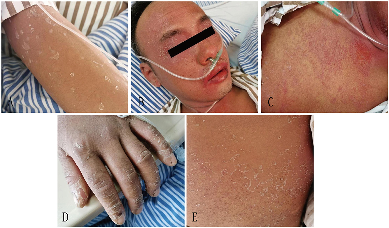 Collage of medical images showing a patient with skin conditions. Image A displays an arm with peeling skin. Image B shows the patient’s face with a nasal oxygen tube and partially obscured eyes. Image C highlights redness and irritation on the chest. Image D depicts a hand with flaking skin. Image E focuses on a section of skin with widespread peeling and irritation. The patient appears to be in a clinical setting, on a striped hospital bed sheet.