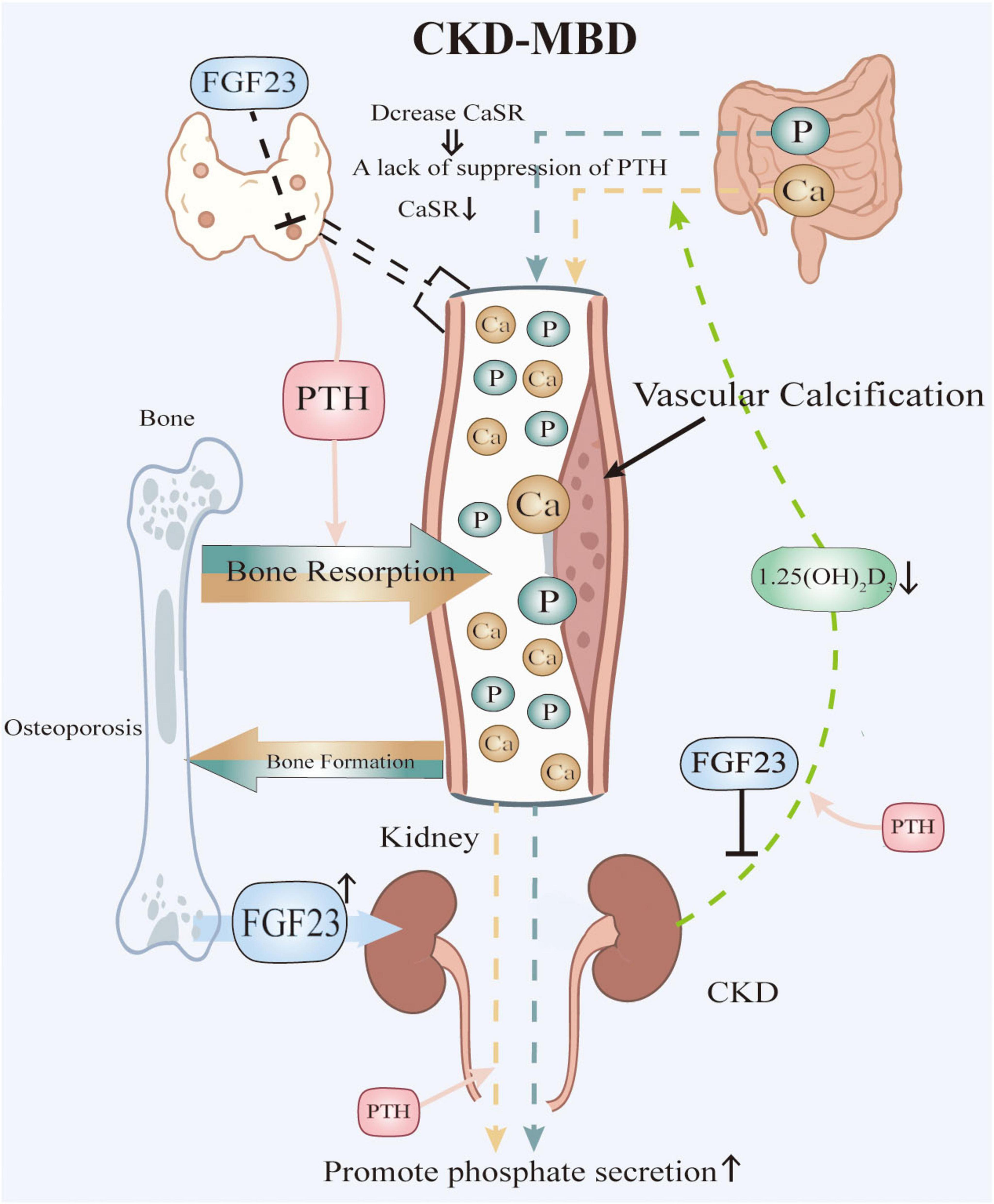 Diagram illustrating CKD-MBD (Chronic Kidney Disease-Mineral and Bone Disorder) pathways. It shows relationships between FGF23, PTH, CaSR, kidneys, bone resorption, and vascular calcification. Arrows indicate processes like phosphate secretion promotion, bone formation, and osteoporosis. Components include a parathyroid gland, intestine, kidneys, and bone, labeled with substances like calcium (Ca) and phosphate (P).