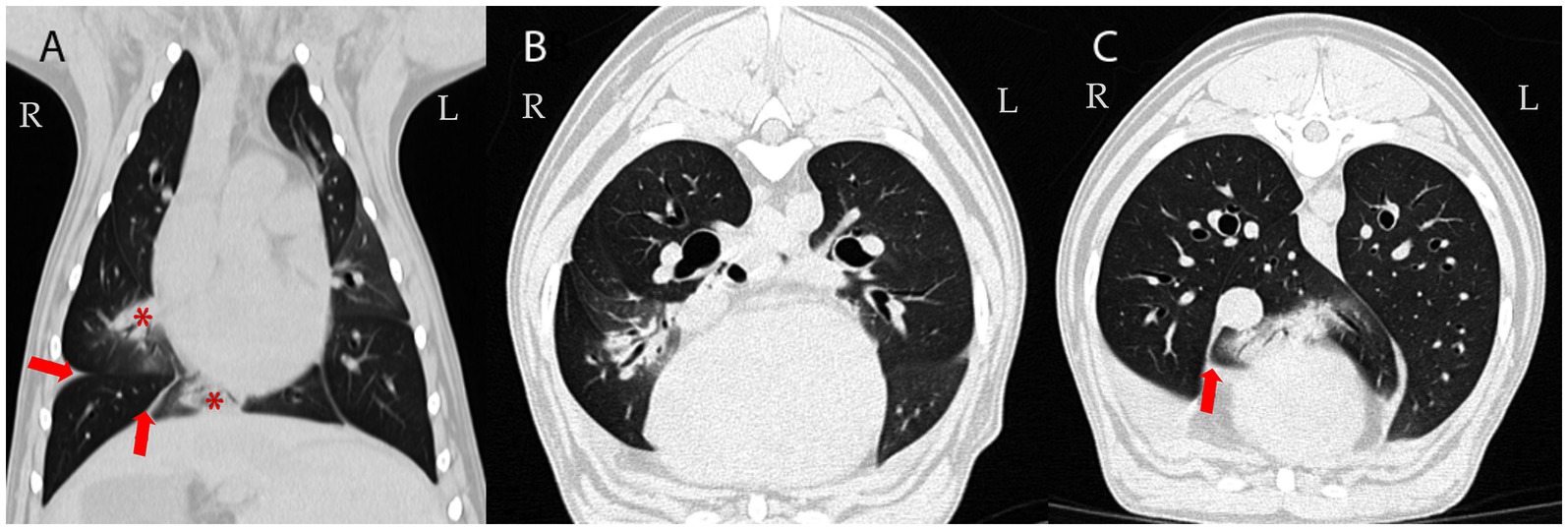 CT scans showing different views of the lungs. Panel A highlights the coronal view with red arrows and asterisks indicating specific areas. Panels B and C display axial views of the lungs, with red arrows pointing to notable regions. The left and right sides are marked as L and R respectively.